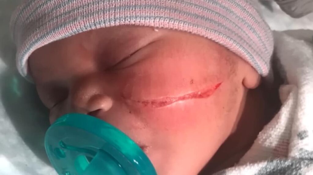 De acordo com o site Bebê Mamãe, um incidente envolvendo um recém-nascido durante um parto cesárea gerou preocupação e levou os pais a se manifestarem publicamente. O bebê precisou receber pontos após o procedimento, o que levantou questões sobre a segurança e os cuidados durante o parto. Segundo a publicação, o caso ocorreu em um hospital cuja identidade não foi revelada, e os detalhes sobre como o incidente aconteceu ainda estão sendo investigados. Os pais, que não tiveram seus nomes divulgados, expressaram sua preocupação e buscaram esclarecimentos junto à equipe médica responsável pelo parto. Conforme relatado pelo site, a situação chamou a atenção para a importância de protocolos rigorosos durante procedimentos cirúrgicos, especialmente em cesáreas, que são consideradas intervenções de rotina, mas que não estão isentas de riscos. A publicação destacou que, embora casos como este sejam raros, eles podem ocorrer e exigem uma resposta rápida e eficaz para garantir a saúde e o bem-estar do recém-nascido. O site Bebê Mamãe também mencionou que os pais estão buscando apoio legal para entender melhor o que ocorreu e para garantir que medidas sejam tomadas para evitar que situações semelhantes aconteçam no futuro. Ainda segundo o Bebê Mamãe, o hospital envolvido no caso afirmou que está conduzindo uma investigação interna para apurar os fatos e que está comprometido em oferecer todo o suporte necessário à família. A instituição ressaltou que a segurança dos pacientes é sua prioridade e que procedimentos são revisados regularmente para minimizar riscos. A publicação finaliza destacando que o bebê está se recuperando bem e que a família espera que a divulgação do caso ajude a aumentar a conscientização sobre a importância de cuidados adequados durante partos cesáreos.