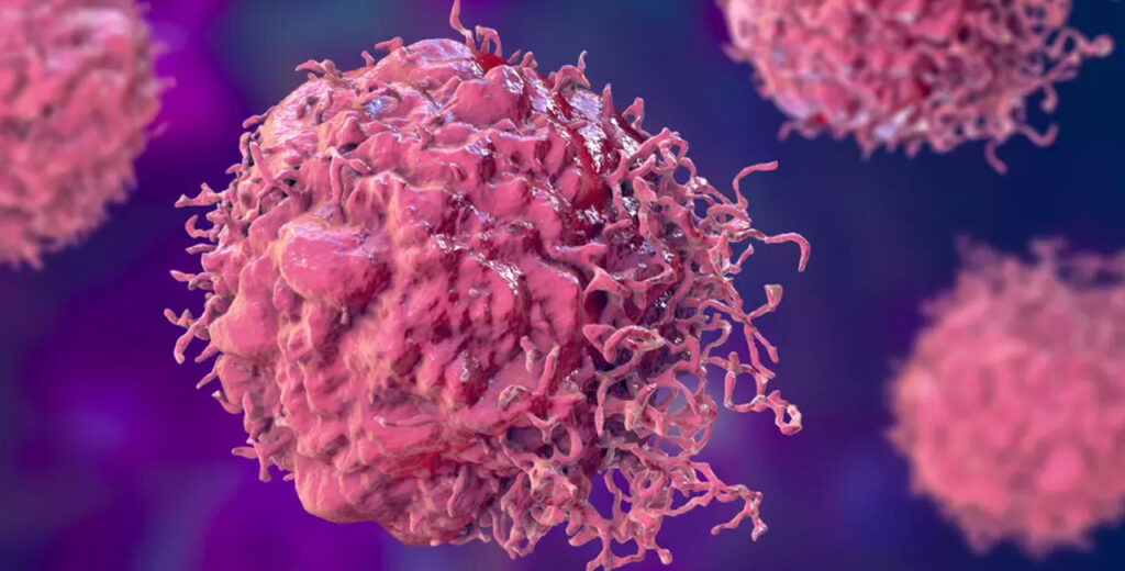 Pesquisadores da **Universidade de Cardiff**, no país de Gales, fizeram uma descoberta que pode transformar o tratamento do câncer em escala global. Eles identificaram uma célula do sistema imunológico, conhecida como célula "T", que possui a capacidade de combater células cancerígenas de diversos tipos, incluindo câncer de **próstata**, **mama**, **pulmão**, **pele**, **osso** e **colo de útero**. Esta descoberta representa um avanço significativo na luta contra o câncer, oferecendo esperança para tratamentos mais eficazes e direcionados. As células "T" são componentes essenciais do sistema imunológico humano, desempenhando um papel crucial na defesa do organismo contra infecções e doenças. A pesquisa da Universidade de Cardiff revelou que essas células possuem um receptor específico que lhes permite identificar e atacar células cancerígenas, enquanto deixam as células saudáveis intactas. Este mecanismo de ação seletivo é fundamental para o desenvolvimento de terapias que minimizem os efeitos colaterais comuns em tratamentos de câncer, como a quimioterapia e a radioterapia. O estudo destaca que a célula "T" descoberta tem a capacidade de reconhecer uma molécula chamada MR1, presente na superfície de muitas células cancerígenas. A interação entre o receptor da célula "T" e a molécula MR1 é o que permite a destruição das células malignas. Este processo é particularmente promissor porque a molécula MR1 é encontrada em uma ampla variedade de tipos de câncer, o que sugere que essa abordagem terapêutica pode ser aplicada a múltiplas formas da doença. A descoberta da célula "T" com capacidade de combater diversos tipos de câncer abre caminho para o desenvolvimento de novas imunoterapias. As imunoterapias são tratamentos que utilizam o próprio sistema imunológico do paciente para combater o câncer, oferecendo uma alternativa mais natural e potencialmente menos tóxica em comparação com os tratamentos convencionais. A pesquisa da Universidade de Cardiff pode levar à criação de terapias personalizadas, onde as células "T" do próprio paciente são modificadas em laboratório para reconhecer e atacar suas células cancerígenas específicas. Além disso, a descoberta pode ter implicações significativas para o tratamento de cânceres que atualmente são difíceis de tratar. Por exemplo, o câncer de pulmão e o câncer de pâncreas são notoriamente resistentes a muitos tratamentos existentes, mas a capacidade da célula "T" de atacar uma ampla gama de células cancerígenas oferece uma nova esperança para pacientes com esses tipos de câncer. Os próximos passos para os pesquisadores incluem a realização de ensaios clínicos para testar a eficácia e a segurança dessa abordagem em humanos. Embora os resultados iniciais sejam promissores, é essencial garantir que o tratamento seja seguro e eficaz em um ambiente clínico antes de ser amplamente disponibilizado. Se bem-sucedidos, esses ensaios podem levar à aprovação de novas terapias que revolucionem o tratamento do câncer. Em resumo, a descoberta da célula "T" pela equipe da **Universidade de Cardiff** representa um avanço significativo na pesquisa do câncer. Com o potencial de tratar uma ampla variedade de tipos de câncer de forma eficaz e com menos efeitos colaterais, essa descoberta oferece uma nova esperança para milhões de pacientes em todo o mundo. A continuidade da pesquisa e o desenvolvimento de ensaios clínicos serão cruciais para transformar essa descoberta em uma realidade clínica que beneficie pacientes globalmente.