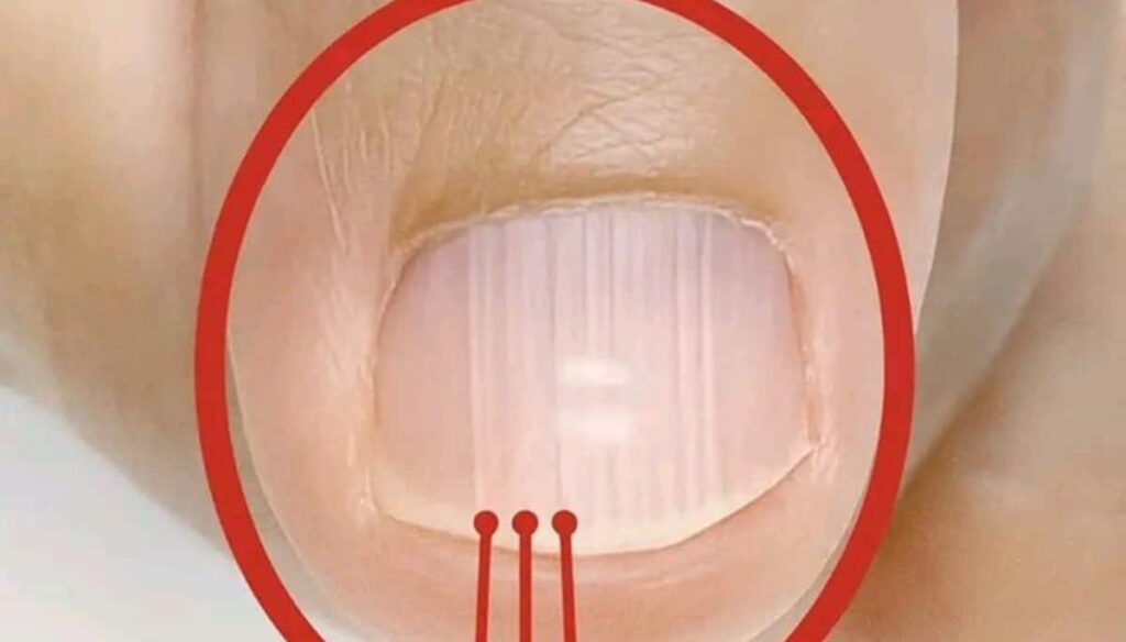 As **linhas nas unhas** que surgem após os 40 anos podem ser mais do que um simples sinal de envelhecimento. Segundo a publicação da Conti Outra, essas linhas, conhecidas como **linhas de Beau**, podem indicar diversas condições de saúde subjacentes. Elas são sulcos ou depressões que se formam transversalmente nas unhas e podem ser causadas por fatores como deficiências nutricionais, doenças sistêmicas ou até mesmo estresse físico ou emocional. É importante prestar atenção a essas alterações, pois elas podem ser um reflexo de algo mais sério acontecendo no corpo. Conforme detalhado pelo site, as **linhas de Beau** podem ser um indicativo de problemas como **deficiência de zinco**, que é essencial para a saúde das unhas e do sistema imunológico. Além disso, doenças como **diabetes** e **problemas circulatórios** também podem se manifestar através dessas linhas. O aparecimento dessas marcas pode ser um sinal de que o corpo está passando por um período de estresse ou trauma, como uma cirurgia recente ou uma doença grave. Portanto, é crucial não ignorar essas mudanças e considerar uma avaliação médica para investigar possíveis causas. Por fim, segundo a publicação, é fundamental adotar uma abordagem preventiva e de monitoramento. Manter uma dieta equilibrada, rica em nutrientes essenciais, pode ajudar a prevenir o aparecimento dessas linhas. Além disso, estar atento a outros sintomas associados pode fornecer pistas valiosas sobre a saúde geral. Consultar um dermatologista ou um profissional de saúde qualificado pode ser um passo importante para entender melhor o que essas **linhas nas unhas** podem estar indicando sobre a saúde após os 40 anos.