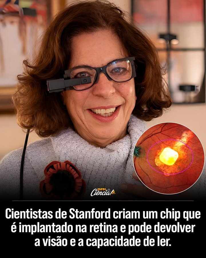 O que é o implante que está revolucionando a visão? O PRIMA é um olho biônico desenvolvido por cientistas da Stanford Medicine. Ele é uma prótese sem fio implantada atrás da retina, que trabalha com óculos inteligentes para restaurar a visão em pacientes com degeneração macular avançada. Como o PRIMA funciona para restaurar a visão? O sistema contorna os fotorreceptores danificados, convertendo imagens em luz infravermelha. Essa luz é enviada diretamente às células neurais da retina ainda ativas, permitindo que os pacientes voltem a enxergar. Quais foram os resultados dos ensaios clínicos? Em um ensaio clínico, 27 dos 32 participantes recuperaram a capacidade de ler. Um paciente avançou 12 linhas na tabela optométrica, um progresso raro em intervenções desse tipo. Quem pode se beneficiar do PRIMA? Pacientes com atrofia geográfica, uma forma grave de degeneração macular que elimina a visão central, mas preserva o restante do sistema visual, podem se beneficiar do PRIMA. Como o PRIMA impacta o dia a dia dos pacientes? Pacientes usam o dispositivo em atividades cotidianas, como ler rótulos no supermercado e se orientar em estações de metrô, melhorando significativamente sua qualidade de vida. Existem efeitos colaterais associados ao uso do PRIMA? Alguns pacientes relataram efeitos colaterais leves, como sensação de pressão ocular ou pequenos sangramentos, mas a recuperação foi rápida. Qual é o futuro do PRIMA e da restauração da visão? Os pesquisadores esperam aumentar a resolução do sistema em cinco vezes, aproximando os pacientes de uma visão mais natural e melhorando ainda mais a qualidade de vida. Por que o PRIMA é considerado um avanço significativo? O PRIMA transforma a restauração da visão de um sonho científico em realidade, oferecendo esperança a muitos que haviam perdido a capacidade de enxergar com clareza. Como o PRIMA se diferencia de outras soluções para degeneração macular? O PRIMA atua diretamente na retina, substituindo fotorreceptores perdidos e permitindo o reconhecimento de formas, letras e sinais essenciais, algo que outras soluções não conseguem fazer com a mesma eficácia. Qual é a importância dos óculos inteligentes no sistema PRIMA? Os óculos inteligentes trabalham em conjunto com o implante, convertendo imagens em luz infravermelha, essencial para o funcionamento do PRIMA e a restauração da visão. Como os avanços no PRIMA podem influenciar outras áreas da medicina? Os avanços no PRIMA podem inspirar novas tecnologias em próteses e dispositivos médicos, ampliando o alcance da medicina regenerativa e das soluções biônicas. O que os pacientes dizem sobre a experiência com o PRIMA? Pacientes relatam uma melhora significativa na qualidade de vida, com a recuperação da capacidade de realizar tarefas diárias que antes eram impossíveis devido à perda de visão. Como a pesquisa "Simultaneous perception of prosthetic and natural vision in AMD patients" contribui para o entendimento do PRIMA? A pesquisa publicada na Nature fornece dados valiosos sobre a eficácia do PRIMA, destacando a possibilidade de percepção simultânea da visão protética e natural em pacientes com degeneração macular.