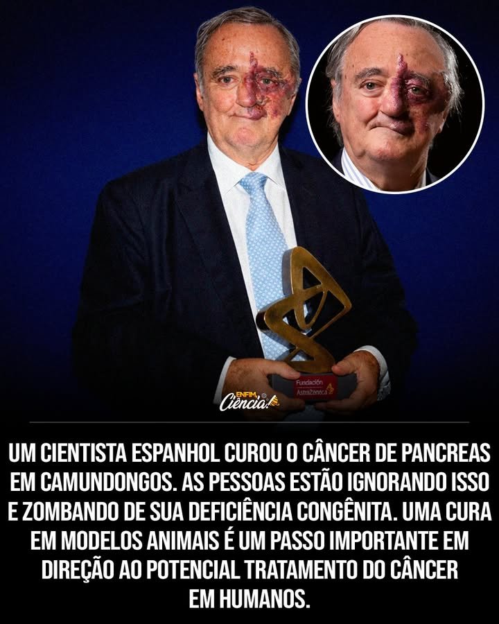 Quem é Mariano Barbacid e qual sua contribuição para a ciência? Mariano Barbacid é um renomado cientista espanhol que liderou uma pesquisa inovadora no Centro Nacional de Pesquisa do Câncer da Espanha, focada em curar o câncer de pâncreas em camundongos. Por que o câncer de pâncreas é considerado tão letal? O câncer de pâncreas é letal devido à sua agressividade e resistência aos tratamentos atuais, tornando-o difícil de detectar e tratar eficazmente. Como Mariano Barbacid conseguiu curar o câncer de pâncreas em camundongos? Barbacid e sua equipe focaram nos mecanismos genéticos dos tumores pancreáticos, permitindo a cura em modelos animais e representando um avanço significativo. Qual a importância de curar o câncer de pâncreas em camundongos? Curar o câncer de pâncreas em camundongos é um grande avanço, pois aproxima a ciência de desenvolver um tratamento eficaz para humanos. Quais são as possíveis consequências dessa descoberta para o tratamento do câncer em humanos? Essa descoberta pode levar ao desenvolvimento de novos tratamentos para o câncer de pâncreas em humanos, aumentando as chances de cura e sobrevivência. Por que algumas pessoas ignoraram ou zombaram da descoberta de Barbacid? Algumas pessoas ignoraram ou zombaram da descoberta devido à deficiência congênita de Barbacid, subestimando sua capacidade científica. Como a deficiência congênita de Barbacid impactou sua carreira? Apesar da deficiência congênita, Barbacid superou desafios e se destacou na pesquisa científica, provando que limitações físicas não definem o potencial de um cientista. Qual é o próximo passo após essa descoberta em camundongos? O próximo passo é testar a eficácia e segurança dos tratamentos em humanos, buscando adaptar as descobertas para uso clínico. Quais são os desafios de adaptar tratamentos de camundongos para humanos? Os desafios incluem diferenças biológicas entre espécies e a necessidade de garantir que os tratamentos sejam seguros e eficazes em humanos. Como a comunidade científica reagiu à descoberta de Barbacid? A comunidade científica reconheceu a importância do avanço, destacando o potencial impacto no tratamento do câncer de pâncreas. Qual é o papel do Centro Nacional de Pesquisa do Câncer da Espanha nessa descoberta? O Centro Nacional de Pesquisa do Câncer da Espanha foi fundamental, fornecendo recursos e suporte para a pesquisa liderada por Barbacid. Como essa descoberta pode influenciar futuras pesquisas sobre câncer? Essa descoberta pode abrir novas linhas de pesquisa, incentivando estudos sobre mecanismos genéticos e tratamentos inovadores para outros tipos de câncer. Qual é a mensagem de esperança que essa descoberta traz para pacientes com câncer de pâncreas? A descoberta traz esperança de que, no futuro, tratamentos eficazes possam aumentar as chances de cura e melhorar a qualidade de vida dos pacientes. Como a sociedade pode apoiar cientistas como Mariano Barbacid? A sociedade pode apoiar cientistas valorizando suas descobertas, fornecendo financiamento e promovendo a inclusão e diversidade na ciência. Por que devemos agradecer a Mariano Barbacid por sua pesquisa? Devemos agradecer a Barbacid por sua dedicação e contribuições significativas para a ciência, que podem transformar o tratamento do câncer. 👏🧬