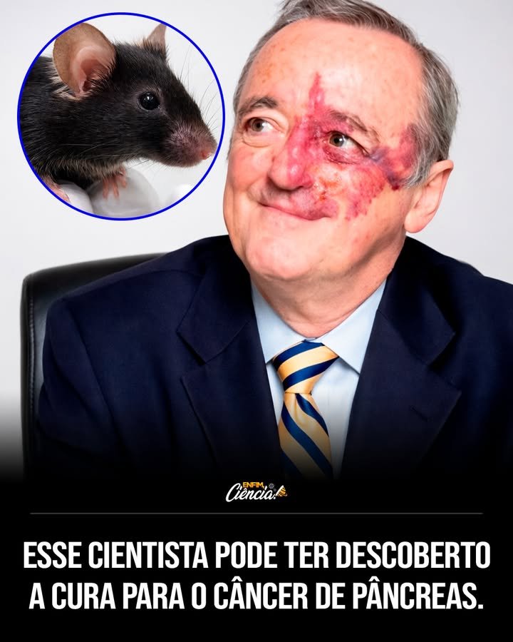 Quem é Mariano Barbacid e qual sua contribuição para a oncologia molecular? Mariano Barbacid é um renomado cientista espanhol, conhecido por revolucionar a compreensão do câncer de pâncreas. Ele desvendou o potencial de bloquear o gene KRAS, presente em mais de 90% dos casos dessa doença. Por que o gene KRAS era considerado "indrogável"? O gene KRAS era visto como "indrogável" porque, por décadas, acreditava-se que ele era inalcançável por medicamentos. Essa percepção dificultava o desenvolvimento de tratamentos eficazes. Como Barbacid e sua equipe conseguiram bloquear o KRAS? Nos estudos pré-clínicos, principalmente em camundongos, a equipe de Barbacid conseguiu desligar o KRAS mutado. Isso foi um marco, pois mostrou que é possível inibir esse gene. Qual foi o impacto do bloqueio do KRAS nos tumores? O bloqueio do KRAS resultou na regressão dos tumores, que pararam de crescer e, em alguns casos, praticamente desapareceram enquanto o gene permanecia inibido. Por que o bloqueio do KRAS é considerado um avanço significativo? Esse avanço é significativo porque derrubou a crença de que os tumores sempre encontrariam rotas alternativas para sobreviver sem o KRAS, algo nunca demonstrado antes com clareza. O que os resultados dos estudos pré-clínicos indicam sobre o câncer de pâncreas? Os resultados indicam que atacar o KRAS é uma estratégia viável, mas ainda não significam uma cura para o câncer de pâncreas. O desafio é transformar esse conhecimento em tratamentos para humanos. Quais são os próximos passos para transformar essa descoberta em tratamento? O próximo passo é desenvolver tratamentos seguros e eficazes, testados em humanos, que possam bloquear o KRAS de forma consistente e sem efeitos adversos. Por que o trabalho de Barbacid é considerado um dos maiores avanços contra o câncer de pâncreas? O trabalho de Barbacid é um marco porque abriu um caminho real para o tratamento do câncer de pâncreas, onde antes só havia impossibilidade e incerteza. Quais são as limitações atuais dessa descoberta? Atualmente, a principal limitação é que os resultados são pré-clínicos e ainda não há uma cura pronta para pacientes. O foco agora é a segurança e eficácia em humanos. Como essa descoberta pode impactar o futuro da oncologia? Essa descoberta pode revolucionar a oncologia ao oferecer novas estratégias para tratar o câncer de pâncreas e possivelmente outros tipos de câncer relacionados ao KRAS. O que diferencia o trabalho de Barbacid de outros estudos sobre o câncer? O diferencial é a clareza com que Barbacid demonstrou a possibilidade de bloquear o KRAS, algo que muitos consideravam impossível, abrindo novas perspectivas de tratamento. Qual é a importância de separar fatos de exageros nessa descoberta? Separar fatos de exageros é crucial para manter expectativas realistas e focar no desenvolvimento de tratamentos viáveis, sem criar falsas esperanças nos pacientes. Como a comunidade científica está reagindo a essa descoberta? A comunidade científica vê essa descoberta como um avanço histórico, mas também com cautela, reconhecendo a necessidade de mais pesquisas para aplicação clínica. Quais são os desafios éticos e científicos na transição para testes em humanos? Os desafios incluem garantir a segurança dos pacientes, a eficácia dos tratamentos e a minimização de efeitos colaterais, além de questões éticas sobre experimentação. Como essa descoberta pode influenciar a pesquisa de outros tipos de câncer? Ela pode inspirar novas abordagens para tratar cânceres relacionados ao KRAS, incentivando a pesquisa de genes antes considerados "indrogáveis" em outros tipos de câncer.