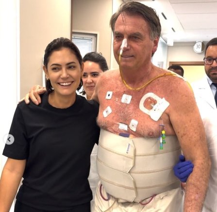 A ex-primeira-dama **Michelle Bolsonaro** compartilhou imagens de **Jair Bolsonaro** durante sua internação no Hospital DF Star, em Brasília. Este evento ocorreu no contexto de uma decisão judicial significativa: o ministro do Supremo Tribunal Federal (STF), **Alexandre de Moraes**, concedeu prisão domiciliar temporária ao ex-presidente por um período de 90 dias. Bolsonaro está hospitalizado desde 13 de março para tratamento de **broncopneumonia**. A decisão do STF permite que ele cumpra a prisão domiciliar com uso de tornozeleira eletrônica e restrições de visitas, conforme parecer favorável da Procuradoria-Geral da República sobre sua condição de saúde. Por que Michelle Bolsonaro compartilhou essas fotos? Segundo a publicação, Michelle destacou sua fé e dedicação ao marido na legenda das fotos. Ela mencionou: “**Celebro as pequenas vitórias. Não me detenho nos detalhes do processo. Sou esposa e mãe, e clamei muito a Deus para que nos ajudasse, para que ele pudesse ir para casa e receber o cuidado necessário**”. Essa declaração reflete seu compromisso contínuo em apoiar Bolsonaro durante seu tratamento e a situação legal em que ele se encontra. Qual é a condição de saúde de Jair Bolsonaro? Desde 13 de março, Bolsonaro está internado para tratar uma broncopneumonia, uma infecção pulmonar que pode ser grave, especialmente em pessoas com histórico de saúde delicado. A decisão de conceder prisão domiciliar foi influenciada por sua condição de saúde, conforme parecer da Procuradoria-Geral da República. O que implica a prisão domiciliar concedida a Bolsonaro? A decisão do STF, segundo a publicação, permite que Bolsonaro cumpra a prisão domiciliar com certas condições. Ele deverá usar uma tornozeleira eletrônica, o que é uma medida comum para monitorar o cumprimento de prisões domiciliares. Além disso, haverá restrições de visitas, o que limita o número de pessoas que podem visitá-lo durante esse período. Como Michelle Bolsonaro está lidando com essa situação? Michelle expressou claramente sua intenção de continuar ao lado de Bolsonaro, afirmando: “**Seguirei cuidando do meu marido, como sempre fiz, com amor, resiliência, dedicação e fé**”. Essa declaração sublinha seu papel de apoio e cuidado contínuo, destacando a importância da família e da fé em momentos de dificuldade. Quais são as implicações legais dessa decisão para Bolsonaro? A concessão de prisão domiciliar é temporária, com duração de 90 dias, e está sujeita a condições específicas, como o uso de tornozeleira eletrônica. Essa medida pode ser vista como uma forma de equilibrar a necessidade de tratamento médico de Bolsonaro com as exigências legais decorrentes de seu processo. Em resumo, a publicação de Michelle Bolsonaro nas redes sociais não apenas compartilha um momento pessoal e familiar, mas também se insere em um contexto legal e de saúde mais amplo. A decisão do STF reflete uma consideração cuidadosa das circunstâncias de saúde de Bolsonaro, enquanto Michelle reafirma seu compromisso de apoio e cuidado durante esse período desafiador.