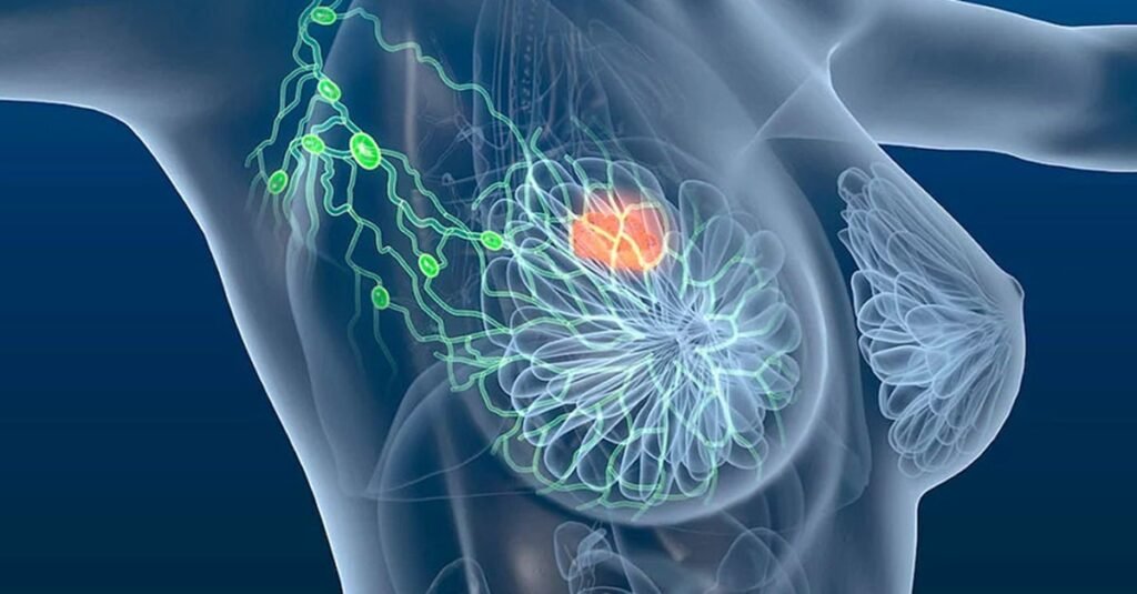 Quais são os sinais precoces do câncer de mama que muitas mulheres ignoram? Alterações na simetria das mamas, mudanças na pele, modificações no mamilo e nódulos na axila são sinais que podem passar despercebidos, mas merecem atenção médica. Por que a simetria das mamas é importante? Mudanças repentinas na simetria, como inchaço ou endurecimento, podem indicar problemas. Observar essas alterações ajuda na detecção precoce. Como a pele da mama pode indicar problemas? Pele mais grossa, com furinhos ou áreas avermelhadas pode sinalizar alterações no tecido mamário. Não ignore essas mudanças, especialmente se persistirem. O que observar nos mamilos? Mudanças repentinas, como retração ou secreção com sangue, devem ser investigadas. Essas alterações podem estar ligadas a problemas nas mamas. Por que a axila também deve ser observada? A presença de nódulos persistentes ou endurecidos na axila pode indicar alterações nos gânglios linfáticos. Não ignore essa área ao fazer autoexames. Como o autoexame pode ajudar na detecção precoce? O autoexame mensal, especialmente após a menstruação, ajuda a identificar mudanças. Conhecer o próprio corpo é essencial para perceber alterações cedo. Qual é o papel da mamografia na prevenção? A mamografia é crucial no rastreamento do câncer de mama. Realizá-la conforme orientação médica aumenta as chances de detecção precoce. O que fazer ao notar alterações nas mamas? Procure avaliação médica ao perceber qualquer mudança. A investigação precoce é fundamental para um tratamento eficaz e menos agressivo.