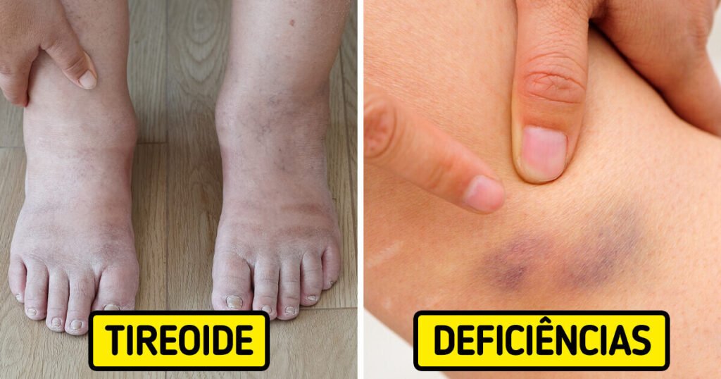 **Quais são os sinais de alerta que o corpo nos envia?** Segundo a publicação, nosso corpo frequentemente nos envia sinais de alerta quando algo não está funcionando corretamente. Esses sinais podem parecer insignificantes à primeira vista, mas, se persistirem, é importante procurar orientação médica. **Tornozelos inchados**, por exemplo, são comuns durante a gravidez, mas, fora desse contexto, podem indicar **má circulação sanguínea**, **problemas cardíacos** ou **disfunções na tireoide**. Em casos menos graves, o inchaço pode ser resultado de uma ingestão excessiva de sal, levando à retenção de água. **O que pode causar sensações estranhas nas pernas e nos pés?** Sensações como rastejamento ou uma vontade incontrolável de mover as pernas podem ser sintomas da **síndrome das pernas inquietas**. Este distúrbio é crônico e geralmente se manifesta à noite, dificultando o descanso. **Como o sistema digestivo pode indicar problemas de saúde?** O sistema digestivo é crucial para a quebra dos alimentos e a eliminação de toxinas. Quando o intestino não está saudável, o corpo pode reagir a certos alimentos, resultando em **intolerâncias alimentares**. Os sintomas incluem **náusea**, **dores de estômago**, **gases**, **cólicas** e **diarreia**. **Por que devemos prestar atenção aos problemas de pele?** Problemas de pele, como coceira e espessamento, podem ser sinais de distúrbios internos, como **problemas hormonais**, **eczema** ou **alergias**. Se esses sintomas persistirem ou piorarem, exames de sangue podem ser necessários. **O que significa ter um tom de pele amarelado?** Um tom de pele amarelado pode ser causado por **icterícia** e problemas hepáticos. Isso ocorre devido a altos níveis de **bilirrubina**, um pigmento da bile, que o corpo não consegue eliminar adequadamente. **Quais são os sintomas da doença de Parkinson?** A **doença de Parkinson** é conhecida por sintomas como **tremores**, **lentidão de movimentos**, **sono ruim**, **pesadelos** e alterações na fala e escrita. **O que pode indicar hematomas aleatórios no corpo?** Hematomas que aparecem sem motivo aparente podem indicar uma **deficiência de vitaminas** ou algo mais sério, como uma **doença de coagulação sanguínea**. **Por que algumas pessoas sentem sono excessivo?** A sensação de querer dormir em qualquer lugar pode ser causada por **doenças autoimunes** ou pelo consumo de bebidas alcoólicas antes de dormir. Esse distúrbio é conhecido como **hipersonia**. **O que unhas curvadas podem indicar?** Unhas que se curvam ao redor dos dedos podem ser um sinal de **problemas pulmonares crônicos** ou **problemas gastrointestinais**. **O que significa um anel branco ou cinza ao redor da córnea?** Em pessoas com menos de 45 anos, um anel branco ou cinza ao redor da córnea pode ser um sinal de **colesterol alto**. **Quais são as causas das contrações musculares?** As **contrações musculares** podem ser causadas por **atividade física**, **estresse**, **desidratação** e **falta de sono**. Em casos mais graves, podem indicar um **distúrbio neurológico** ou uma **doença renal**. **Por que algumas pessoas têm desejo por comida salgada?** Um desejo incontrolável por comida salgada pode indicar **deficiência de ferro**, **anemia**, **desidratação** ou **síndrome pré-menstrual**. **O que pode significar o desejo de triturar gelo?** O desejo de triturar gelo pode ser um sinal de **deficiência de ferro** ou **anemia**. Exames de sangue podem ser necessários para determinar a necessidade de suplementos. **O que as fezes podem revelar sobre a saúde?** A cor e a forma das fezes podem fornecer informações valiosas sobre a saúde geral. Embora possa parecer desagradável, observar esses aspectos pode ajudar a identificar problemas de saúde subjacentes.