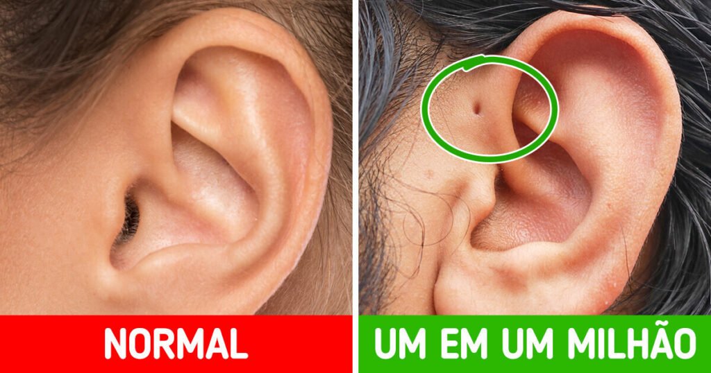 **Quais são algumas características raras do corpo humano que podem revelar segredos sobre a saúde?** Segundo a publicação, o corpo humano é um sistema complexo e ainda há muitos aspectos inexplorados. Algumas características raras podem fornecer insights sobre a saúde e a individualidade de cada pessoa. **O que é a fossa pré-auricular e qual a sua importância?** A fossa pré-auricular é um pequeno orifício próximo à orelha, uma condição rara que pode ocorrer em uma ou ambas as orelhas, sendo mais frequente no lado direito. Geralmente, é uma característica benigna e não representa problemas de saúde. **Como a anoníquia congênita afeta as pessoas?** A anoníquia congênita é uma condição rara em que a pessoa nasce sem unhas nos dedos das mãos e dos pés. Apesar de parecer assustador, essa condição não afeta a saúde de forma significativa. Em alguns casos, apenas algumas unhas podem estar ausentes. **O que é trimetilaminúria e como ela se manifesta?** A trimetilaminúria, também conhecida como odor corporal constante, é uma condição rara com cerca de 100 casos registrados. O corpo humano contém trimetilamina, uma substância com odor de peixe. Normalmente, o metabolismo processa essa substância, mas algumas pessoas não conseguem, resultando em um odor de peixe exalado pelo suor ou hálito. **O que caracteriza o superpaladar?** Algumas pessoas nascem com mais papilas gustativas, uma condição chamada de **superpaladar**. Essas pessoas são mais sensíveis a sabores amargos em alimentos como café, chocolate e brócolis. Cerca de 25% da população possui essa habilidade, sendo mais comum em mulheres. **Como a mutação genética LRP5 afeta os ossos?** A mutação genética LRP5 resulta em ossos extremamente densos. Descoberta após um homem sobreviver a um acidente de carro sem fraturas, essa condição torna os ossos resistentes a fraturas e capazes de substituir minerais ósseos antigos em resposta a novas demandas funcionais. **O que é tetracromacia e quem pode ter essa condição?** A tetracromacia é a capacidade rara de ver cores extras. Enquanto a maioria das pessoas vê cores através de três fotorreceptores (azul, verde e vermelho), pessoas com tetracromacia possuem um quarto fotorreceptor. Cerca de 12% das mulheres têm essa condição. **A síndrome do lobisomem é real?** Conhecida como hipertricose, a síndrome do lobisomem é caracterizada pelo crescimento excessivo de pelos em todo o corpo. É extremamente rara, com apenas 50 casos documentados. As causas não são bem conhecidas, mas a condição pode ser hereditária e estar presente desde o nascimento. **Qual é a função das amígdalas e por que podem ser removidas?** As amígdalas estão localizadas na parte posterior da garganta e impedem a entrada de germes pela boca. Elas geralmente diminuem com a idade, mas podem se infectar e necessitar de remoção através de amigdalectomia. Essas características raras do corpo humano não apenas destacam a complexidade e a individualidade de cada pessoa, mas também revelam segredos sobre a saúde que ainda estão sendo desvendados pela ciência.