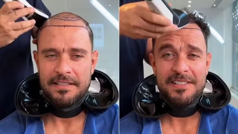 Por que Diogo Nogueira decidiu fazer um transplante capilar? Diogo Nogueira, cantor de 44 anos, optou por um transplante capilar para mudar seu visual, gerando expectativa entre os fãs nas redes sociais. Quem foi o cirurgião responsável pelo procedimento? O cirurgião Tony Ruston foi o responsável pelo transplante capilar de Diogo Nogueira, destacando o desafio devido a irregularidades na linha do cabelo e densidade dos fios. Quando Diogo Nogueira revelará mais detalhes sobre sua transformação? O cantor prometeu compartilhar mais detalhes sobre sua transformação no próximo sábado, mantendo os fãs curiosos. Como os fãs reagiram ao novo visual de Diogo Nogueira? Os fãs expressaram opiniões diversas sobre a mudança, com alguns elogiando e outros sentindo falta do visual anterior. Quais foram os desafios enfrentados no transplante capilar de Diogo Nogueira? O caso de Diogo era desafiador devido à linha do cabelo baixa e irregularidades na densidade e angulação dos fios. Qual foi o impacto do anúncio do novo visual nas redes sociais? O anúncio gerou grande expectativa e curiosidade entre os fãs, com muitos aguardando ansiosamente a revelação completa.