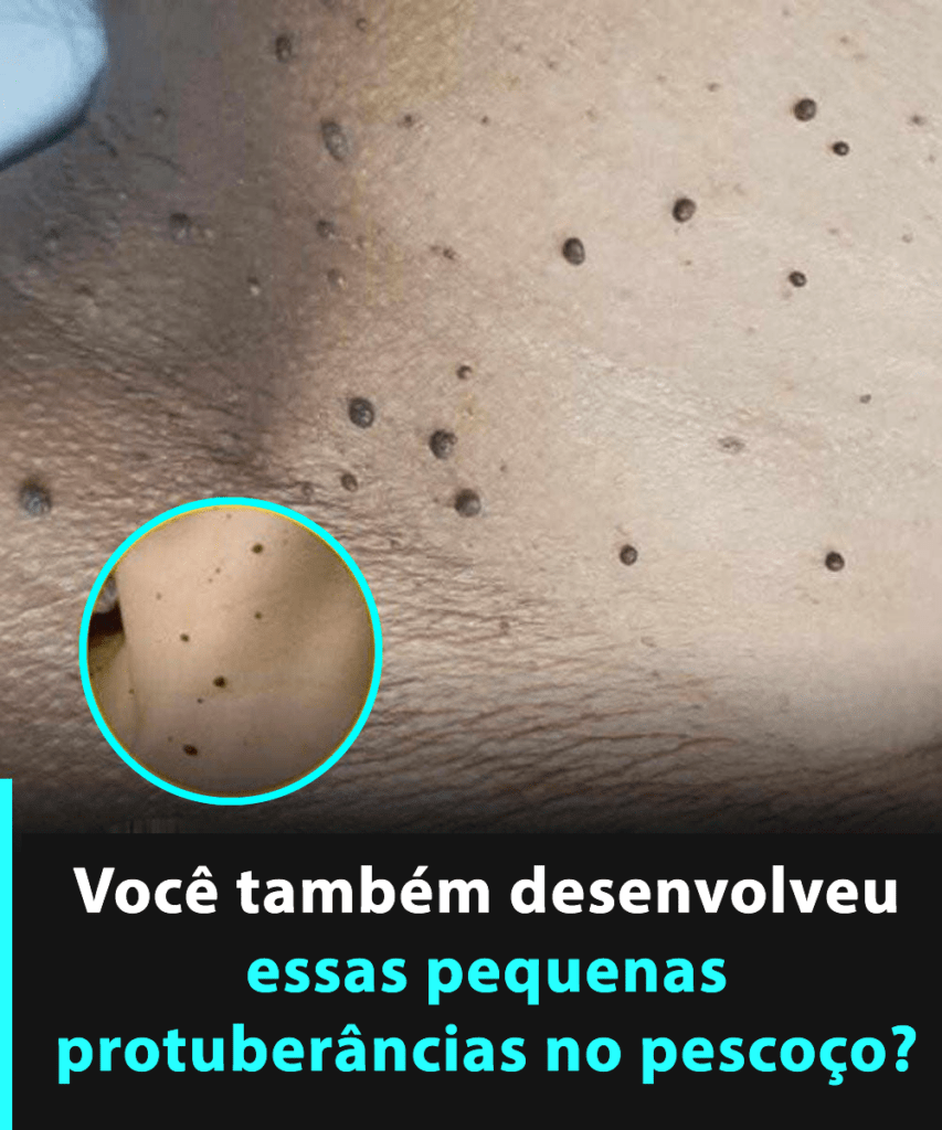 Se você notou esses pequenos pedaços de pele no pescoço ou nas axilas, pode ser que…