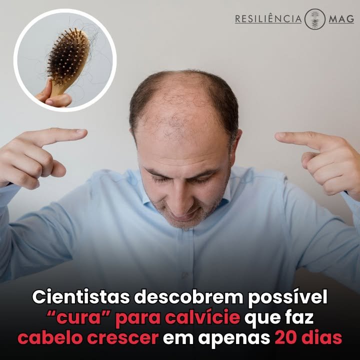 Cientistas descobrem possível “cura” para calvície que faz cabelo crescer em apenas 20 dias