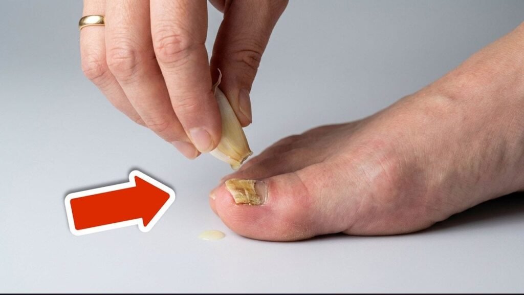 Use isto e a micose de unha desaparecerá para sempre (incrivelmente rápido)