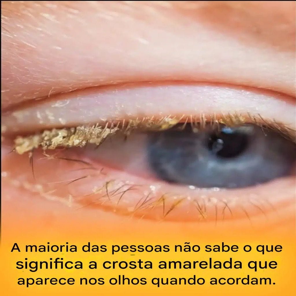 Crosta amarela no canto dos olhos ao acordar: o que isso quer dizer?