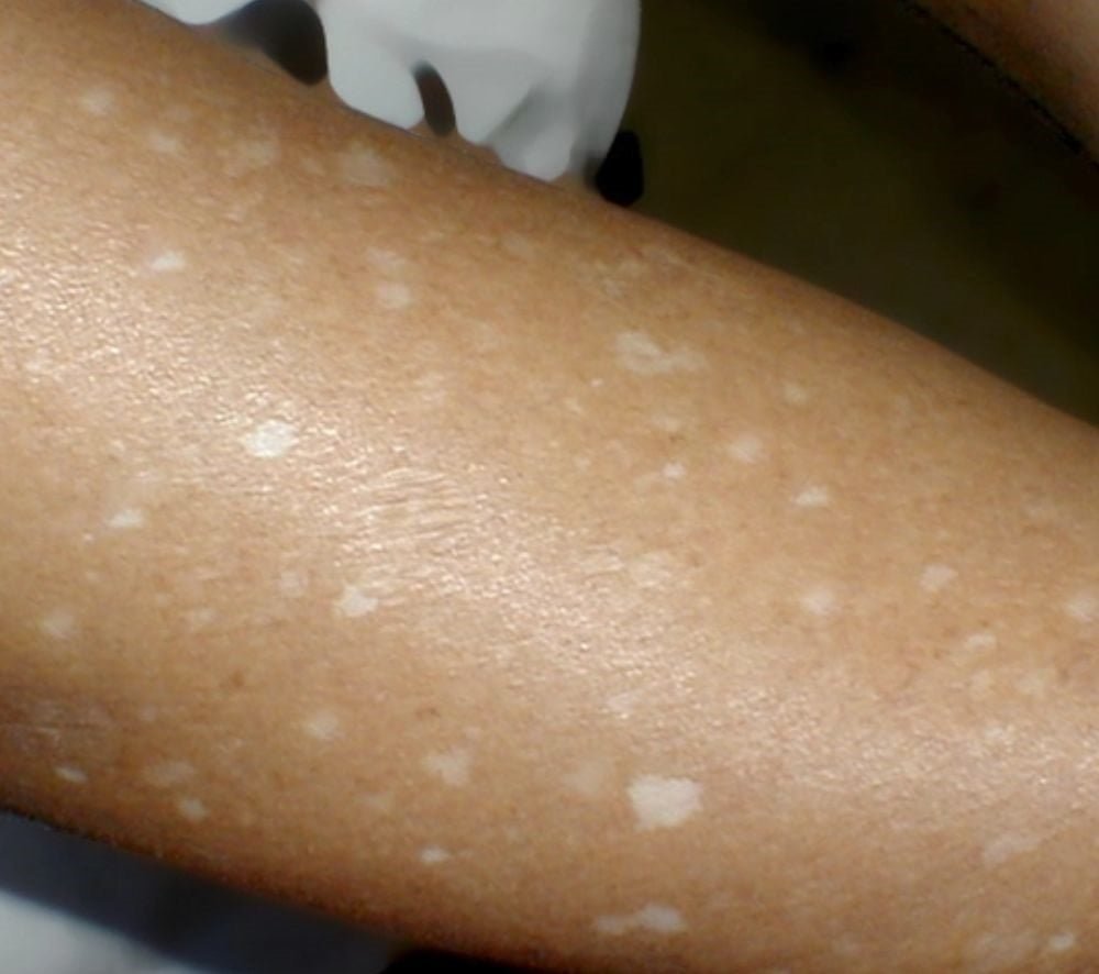 O que pode estar por trás das manchas brancas na pele? Veja as possíveis causas