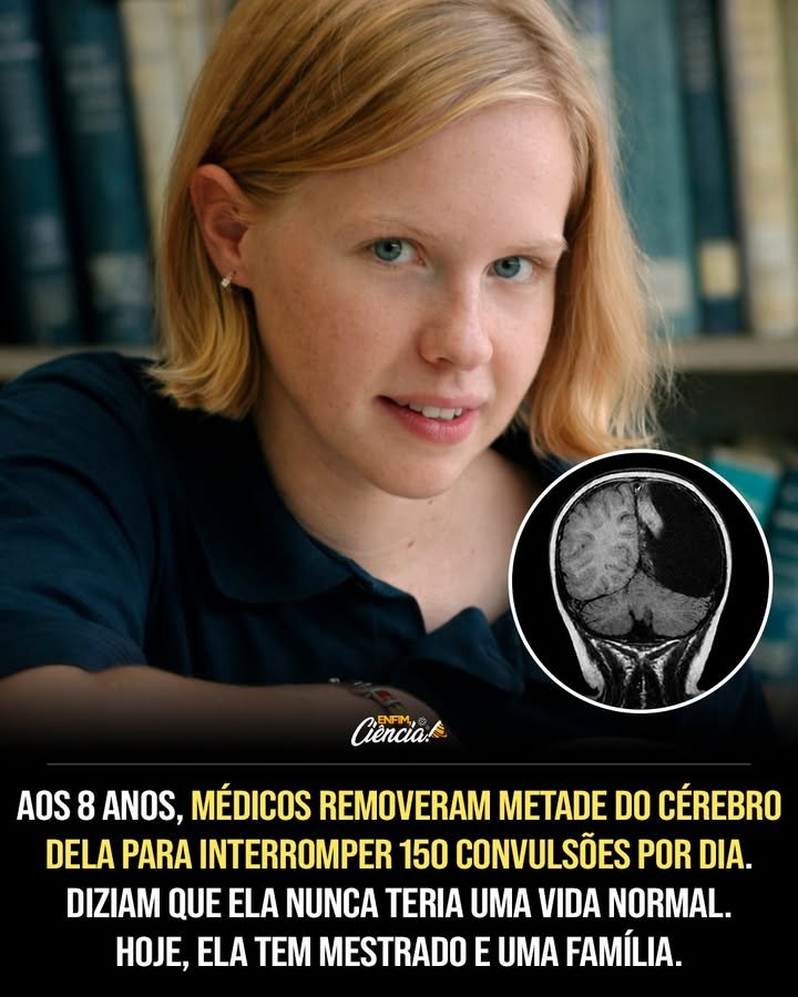 Ela perdeu metade do cérebro — e, ainda assim, construiu uma vida que parecia impossível. Como isso pode acontecer sem destruir tudo? A resposta começa de um jeito assustador: ainda criança, ela passou a sofrer **convulsões constantes**, crises tão frequentes e intensas que o próprio corpo já não parecia obedecer. Não era algo passageiro, nem um quadro que pudesse ser controlado com facilidade. Era uma escalada rápida, brutal, e cada novo episódio levantava uma pergunta ainda mais inquietante: até onde o corpo humano consegue resistir? O que estava provocando isso? Os médicos descobriram uma condição **neurológica extremamente rara**, chamada **encefalite de Rasmussen**. Trata-se de uma doença **autoimune** em que o sistema imunológico, em vez de proteger, começa a atacar o próprio cérebro. No caso dela, o alvo era o **lado direito do cérebro**. E é aqui que muita gente se surpreende: não era apenas uma inflamação qualquer. Era um processo progressivo, agressivo, que fazia as crises se multiplicarem de forma alarmante. Mas quão grave isso ficou? Em pouco tempo, ela chegou a sofrer **até 150 convulsões por dia**. Algumas eram tão violentas que seu corpo inteiro tremia. Dá para imaginar o que isso significa para uma criança? A rotina desaparece, a segurança desaparece, e o futuro começa a parecer cada vez mais estreito. Então surge a pergunta inevitável: os remédios não poderiam controlar a situação? Seria o caminho mais esperado, mas não foi o que aconteceu. Os **medicamentos anticonvulsivantes** simplesmente **não funcionaram**. E quando os tratamentos mais comuns falham, o que sobra? Foi nesse ponto que os médicos deram aos pais um aviso devastador: sem uma intervenção radical, ela poderia **morrer** ou sofrer **danos cerebrais permanentes**. Mas há um detalhe que quase ninguém percebe nesse tipo de decisão: quando a única escolha possível parece impensável, ela deixa de ser apenas uma opção médica e vira uma aposta total no desconhecido. Que intervenção era essa? Uma cirurgia raríssima chamada **hemisferectomia**, um procedimento em que **metade do cérebro é removida**. Sim, removida. E antes mesmo de entender como alguém pode sobreviver a isso, surge outra dúvida ainda maior: o que se perde quando se tira metade de algo tão essencial? Os riscos eram enormes. Os médicos alertaram que ela poderia **perder a capacidade de falar**, desenvolver **graves limitações cognitivas** ou depender de cuidados pelo resto da vida. Ainda assim, a operação aconteceu. Durou cerca de **14 horas** e removeu completamente o **lado direito do cérebro**. O que acontece depois muda tudo, porque a cirurgia não encerrou o drama — ela apenas abriu uma nova fase, talvez ainda mais imprevisível. Ela saiu ilesa? Não. Após a cirurgia, ficou com **paralisia parcial no lado esquerdo do corpo** e perdeu parte da **visão periférica**. Então como essa história pode ser tão extraordinária? Porque, contra quase todas as previsões, algo começou a acontecer dentro do cérebro que restou. O **lado esquerdo** passou a se **reorganizar** e a assumir funções do lado removido. Esse fenômeno tem nome: **neuroplasticidade**. Mas até onde essa adaptação poderia ir? Essa é a parte que prende qualquer um até o fim, porque não estamos falando apenas de sobrevivência. Estamos falando de reconstrução. Aos poucos, ela não apenas continuou viva — ela começou a avançar. E aqui está o ponto em que a maioria não espera o desfecho: aquela menina, diagnosticada aos **8 anos** com uma doença devastadora, era **Christina Santhouse**. E o que ela fez com a vida depois de tudo isso? Christina concluiu o **ensino médio**, fez **faculdade**, conquistou um **mestrado em fonoaudiologia** e passou a trabalhar ajudando pessoas com **dificuldades de comunicação**. Há algo profundamente simbólico nisso: depois de enfrentar o risco de perder funções essenciais, ela dedicou a própria vida a ajudar outras pessoas a encontrarem a sua voz. Então essa história é sobre perder metade do cérebro? Sim, mas não só. É também sobre o que o cérebro ainda pode fazer quando tudo parece ter sido tirado. Sobre o que a medicina arrisca quando não há alternativa. E, principalmente, sobre como **Christina Santhouse** transformou um prognóstico devastador em uma vida de propósito. Só que a pergunta que fica no ar talvez seja a mais impressionante de todas: se o cérebro humano é capaz de se reorganizar assim, quantos limites que parecem definitivos talvez ainda não tenham sido totalmente compreendidos?