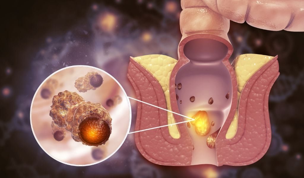 O câncer de ânus existe, e muitas pessoas o confundem com hemorróidas até que seja tarde demais