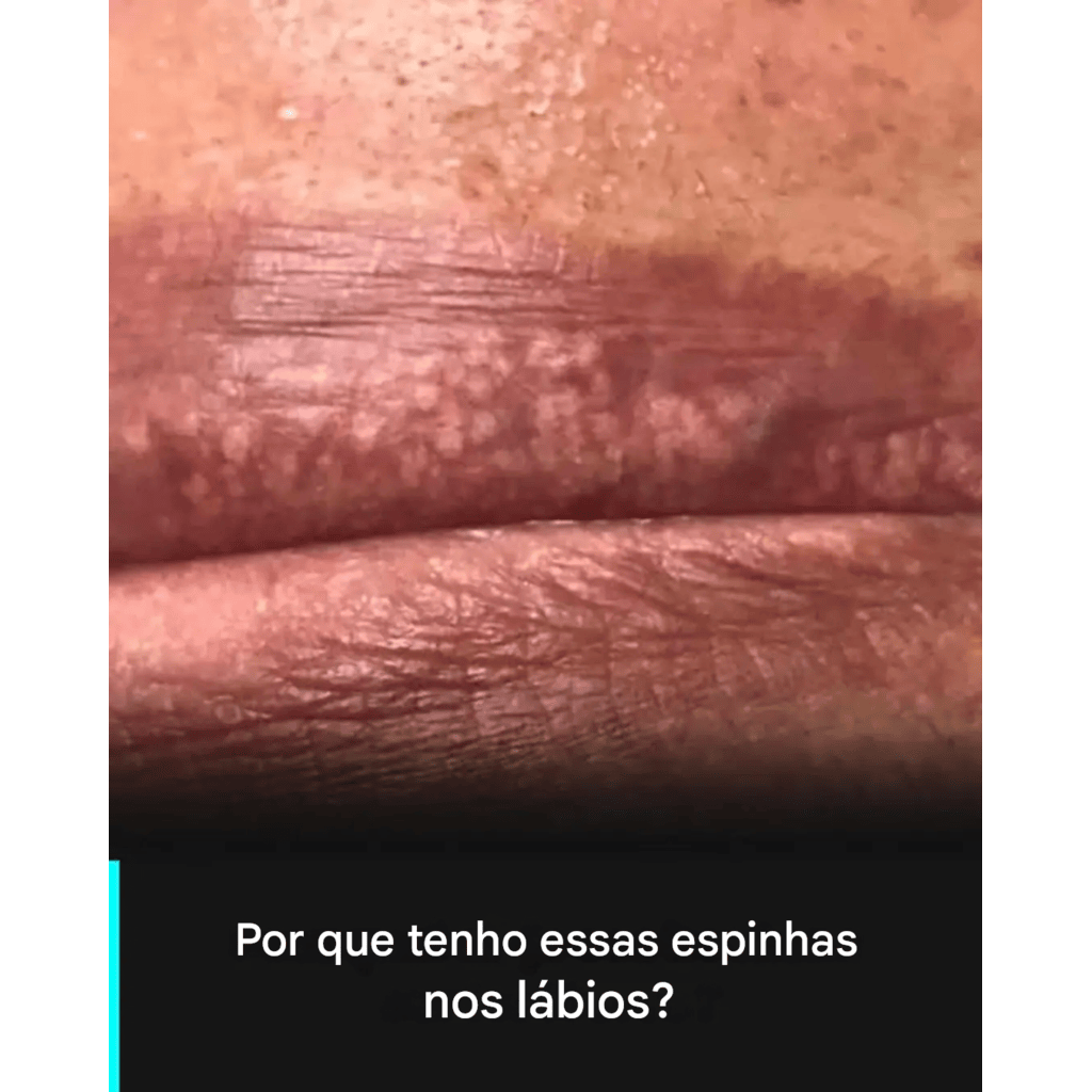 Por que tenho “espinhas” nos lábios: o que são e como lidar com elas