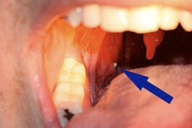 O que são essas ‘pedras brancas’ que aparecem na boca que causam mau hálito?