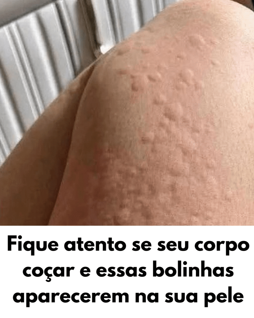 Por que a urticária aparece na pele? Fatores surpreendentes que você pode não saber