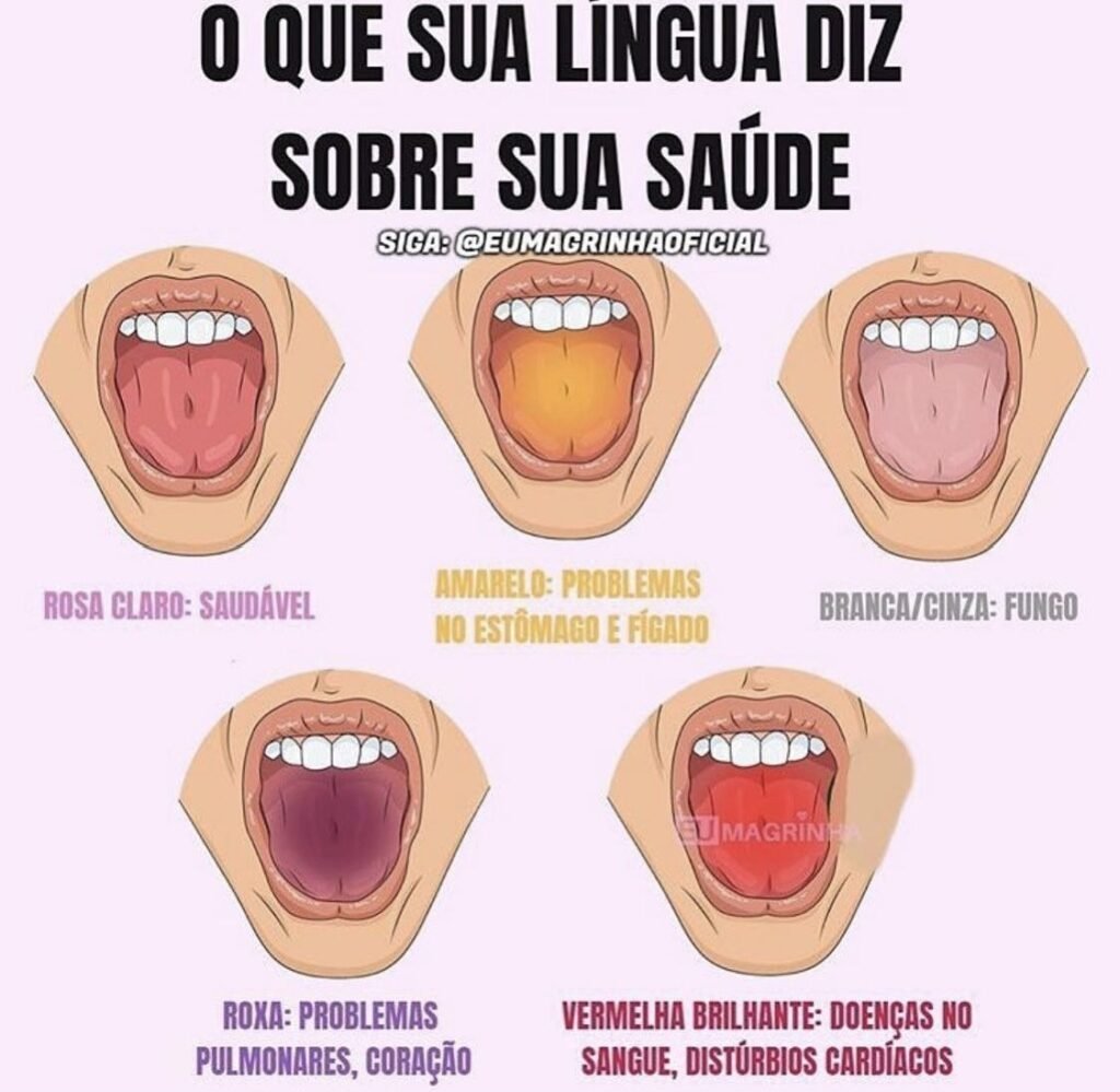 Você olha para a **língua** todos os dias, mas quase nunca percebe o que ela pode estar tentando dizer sobre a sua **saúde**. Será que a cor dela realmente significa alguma coisa ou isso é só exagero? A resposta é que, em muitos casos, mudanças visíveis podem funcionar como um **sinal de alerta**. E justamente por parecer algo simples demais, muita gente ignora. Mas existe um detalhe que quase passa despercebido: não é só a aparência em si que chama atenção, e sim o que cada tonalidade pode sugerir. Então o que uma língua considerada normal mostra? De forma geral, a referência apresentada é a **rosa claro**, associada a um aspecto **saudável**. Isso não quer dizer perfeição absoluta, nem substitui avaliação médica, mas serve como base para comparar alterações. E quando essa cor muda, surge a pergunta que realmente importa: mudar para qual tom? Se ela aparece **branca** ou **cinza**, o que isso pode indicar? Segundo as informações apresentadas, essa coloração está ligada a **fungo**. E é aqui que muita gente se surpreende, porque algo que parece apenas uma camada passageira pode estar relacionado a uma condição que merece atenção. Mas será que toda mudança clara é igual? Nem sempre, e esse é o ponto que faz muita gente continuar observando sem entender o que está vendo. E quando a língua fica **roxa**? Esse é um dos sinais que mais despertam preocupação, porque a indicação associada é de possíveis **problemas pulmonares** e também do **coração**. O que acontece depois dessa informação muda a forma como muita gente enxerga algo tão comum quanto abrir a boca diante do espelho. Porque, de repente, aquilo que parecia apenas uma variação de cor passa a carregar um possível recado do corpo. Mas há uma mudança que chama ainda mais atenção: e se a língua estiver **vermelha brilhante**? Nesse caso, a associação mostrada é com **doenças do sangue** e **distúrbios cardíacos**. E aqui surge outra dúvida inevitável: como algo tão pequeno pode apontar para questões tão importantes? A resposta está no fato de que o corpo costuma dar sinais visíveis antes mesmo de muita gente decidir prestar atenção. Só que existe um ponto que quase ninguém percebe logo de início. Não se trata de olhar uma vez e tirar conclusões definitivas. O que chama atenção é a **persistência** da alteração, o contraste com o aspecto habitual e o fato de que certas cores aparecem ligadas a condições específicas. Isso muda tudo, porque o foco deixa de ser a curiosidade e passa a ser a observação consciente. Então qual é a grande mensagem por trás disso? Que a **língua** pode funcionar como um indicador visual importante. **Rosa claro** aparece como sinal de normalidade. **Branca ou cinza** pode sugerir **fungo**. **Roxa** pode estar relacionada a **problemas pulmonares** e ao **coração**. **Vermelha brilhante** pode apontar para **doenças do sangue** e **distúrbios cardíacos**. Parece simples, mas não é um detalhe pequeno. E por que tanta gente só percebe isso tarde demais? Porque sinais visíveis costumam ser tratados como algo sem importância, principalmente quando não causam dor imediata. Só que o corpo nem sempre avisa de forma dramática. Às vezes, ele começa por mudanças discretas, silenciosas, quase banais. E esse é o tipo de coisa que muita gente vê sem realmente enxergar. No fim, o ponto principal não é apenas a cor da língua. É o que ela pode estar tentando antecipar antes que o problema fique impossível de ignorar. E talvez a pergunta mais importante não seja “que cor ela está hoje?”, mas sim “há quanto tempo ela deixou de parecer normal?”. Porque quando esse detalhe entra no seu radar, fica difícil olhar do mesmo jeito outra vez.