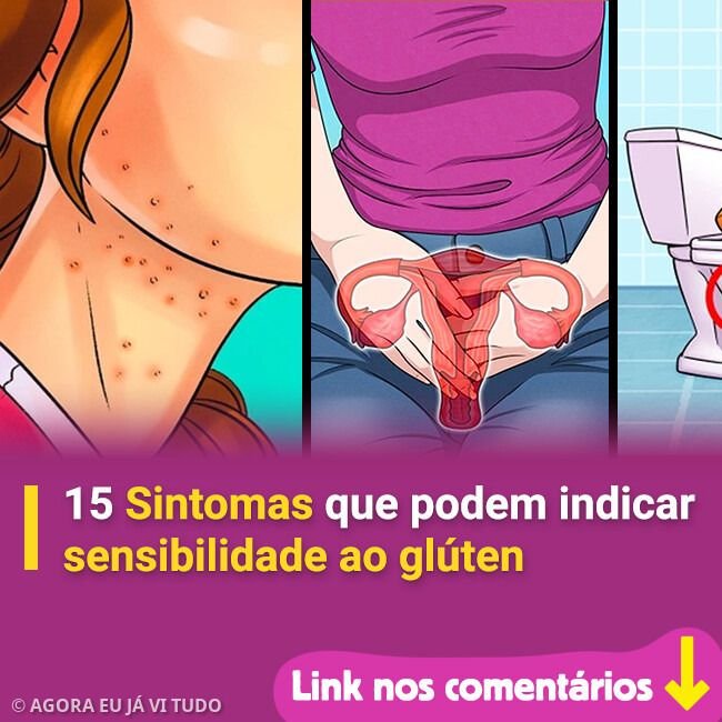 **15 Sintomas que Podem Indicar Sensibilidade ao Glúten** A **sensibilidade ao glúten** é uma condição que afeta muitas pessoas ao redor do mundo, mas que muitas vezes passa despercebida devido à variedade de sintomas que pode causar. Este artigo explora 15 sintomas que podem indicar que você tem sensibilidade ao glúten, ajudando a identificar se essa pode ser uma preocupação para você. **O que é sensibilidade ao glúten?** A sensibilidade ao glúten é uma reação adversa ao glúten, uma proteína encontrada no trigo, cevada e centeio. Diferente da doença celíaca, a sensibilidade ao glúten não causa danos permanentes ao intestino delgado, mas pode causar desconforto significativo. **Quais são os sintomas comuns de sensibilidade ao glúten?** 1. **Inchaço Abdominal**: Você sente seu estômago inchado após consumir alimentos que contêm glúten? O inchaço é um dos sintomas mais comuns e pode ser acompanhado por gases e desconforto abdominal. 2. **Diarreia ou Constipação**: Alterações nos hábitos intestinais, como diarreia frequente ou constipação, podem ser um sinal de que seu corpo está reagindo ao glúten. 3. **Dor Abdominal**: A dor abdominal é um sintoma frequente e pode variar de leve a intensa, dependendo da quantidade de glúten ingerida. 4. **Fadiga**: Sentir-se constantemente cansado ou exausto, mesmo após uma noite de sono adequada, pode ser um indicativo de sensibilidade ao glúten. 5. **Dores de Cabeça**: Dores de cabeça frequentes, incluindo enxaquecas, podem ser desencadeadas pelo consumo de glúten em pessoas sensíveis. 6. **Dor nas Articulações**: Algumas pessoas experimentam dor e inflamação nas articulações após consumir glúten. 7. **Náusea**: Sentir-se enjoado ou ter uma sensação de mal-estar após comer alimentos que contêm glúten é outro sintoma comum. 8. **Erupções Cutâneas**: Problemas de pele, como erupções cutâneas ou eczema, podem ser exacerbados pelo consumo de glúten. 9. **Depressão e Ansiedade**: Alterações de humor, incluindo depressão e ansiedade, têm sido associadas à sensibilidade ao glúten. 10. **Confusão Mental**: Muitas pessoas relatam uma sensação de "nevoeiro cerebral", onde têm dificuldade de concentração e clareza mental. 11. **Perda de Peso Inexplicada**: Perder peso sem motivo aparente pode ser um sinal de que seu corpo não está absorvendo nutrientes adequadamente devido à sensibilidade ao glúten. 12. **Anemia por Deficiência de Ferro**: A má absorção de nutrientes pode levar à anemia, especialmente a deficiência de ferro. 13. **Formigamento nas Extremidades**: Sensações de formigamento ou dormência nas mãos e pés podem ser um sintoma neurológico relacionado ao glúten. 14. **Desequilíbrios Hormonais**: O glúten pode afetar o equilíbrio hormonal, levando a sintomas como ciclos menstruais irregulares. 15. **Problemas Dentários**: A sensibilidade ao glúten pode afetar a saúde dental, resultando em problemas como aftas e esmalte dental fraco. **Como saber se você tem sensibilidade ao glúten?** Se você suspeita que pode ter sensibilidade ao glúten, é importante consultar um médico. Eles podem recomendar testes para descartar a doença celíaca e outras condições. Um teste de eliminação, onde você remove o glúten da sua dieta por um período e observa se os sintomas melhoram, também pode ser útil. **Qual é o tratamento para a sensibilidade ao glúten?** O tratamento mais eficaz é seguir uma **dieta sem glúten**. Isso significa evitar todos os alimentos que contêm trigo, cevada e centeio. Existem muitas alternativas sem glúten disponíveis hoje, tornando mais fácil seguir essa dieta. **Conclusão** A sensibilidade ao glúten pode causar uma ampla gama de sintomas que afetam a qualidade de vida. Reconhecer esses sintomas e buscar orientação médica é crucial para gerenciar a condição de forma eficaz. Se você experimenta algum dos sintomas mencionados, considere discutir com um profissional de saúde a possibilidade de sensibilidade ao glúten.