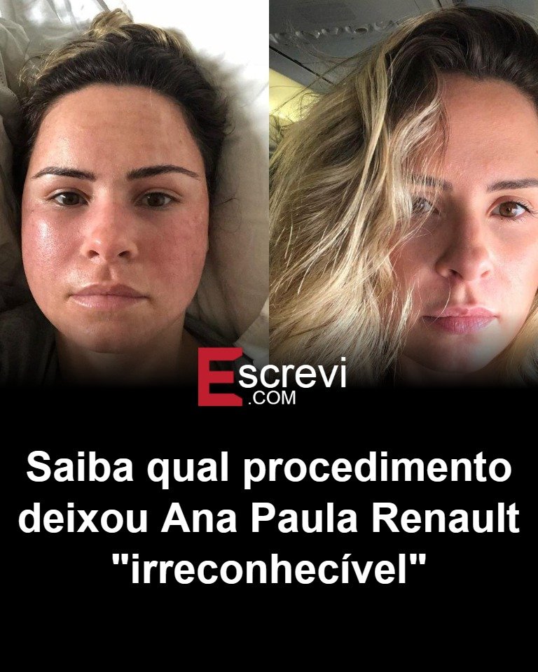 Bastou uma sequência de imagens antigas voltar a circular para muita gente fazer a mesma pergunta: o que deixou **Ana Paula Renault** tão diferente a ponto de ser chamada de “irreconhecível”? A dúvida cresceu porque os registros não são exatamente novos. As fotos são de **2019**, mas reapareceram agora nas redes sociais e ganharam força por causa das comparações com a aparência atual da participante do grupo de veteranos do **BBB 26**. Só que, olhando rápido, a mudança parece maior do que realmente é. Então, o que chamou tanta atenção? Naquele período, ela surgiu com um visual bem diferente do que o público está acostumado a ver hoje. Os **cabelos** e as **sobrancelhas** estavam mais escuros, e o **rosto** aparecia mais cheio. Mas seria apenas uma mudança de estilo? Não exatamente. E é aí que muita gente começa a se surpreender. O que havia por trás dessa transformação não era uma simples troca de maquiagem ou iluminação de foto. A própria jornalista explicou, em uma publicação no **Instagram**, que enfrentava havia anos problemas de **melasma** e **acne**. E, diante disso, decidiu investir em **tratamentos dermatológicos**. Mas há um ponto que quase passa despercebido: quando alguém vê o antes e o depois sem conhecer esse contexto, a tendência é imaginar algo muito mais radical. Então foi um único procedimento que mudou tudo? O que se sabe, diretamente ligado ao que foi publicado, é que a alteração na aparência aconteceu após a realização de um **procedimento estético**, dentro desse processo de cuidados com a pele. Isso ajuda a entender por que as imagens antigas causaram tanto impacto agora. Não se tratava apenas de uma fase diferente, mas de um momento em que ela estava lidando com questões específicas e buscando tratamento. Mas por que essas fotos voltaram a repercutir justamente agora? Porque a presença de **Ana Paula Renault** no **BBB 26** recolocou seu nome em evidência, e qualquer comparação entre passado e presente ganha outra dimensão nas redes. O público não vê só uma imagem antiga: vê uma versão que contrasta com a atual e tenta encontrar uma explicação imediata. Só que o que acontece depois muda a leitura de tudo. Quando se descobre que ela mesma já havia falado sobre **melasma**, **acne** e os cuidados dermatológicos, a narrativa muda. A aparência que muitos classificaram como “irreconhecível” deixa de parecer um mistério absoluto e passa a ser entendida como resultado de um processo estético e de tratamento. Ainda assim, por que a reação foi tão intensa? Porque mudanças no rosto sempre geram mais comentários do que qualquer outra transformação. Um cabelo mais escuro pode ser notado. Sobrancelhas diferentes também. Mas quando isso aparece junto de um rosto mais cheio, a percepção do público se amplifica. E aqui está o detalhe que quase ninguém percebe de primeira: nem toda mudança visual nasce de uma decisão puramente estética; às vezes, ela vem de uma tentativa de resolver algo que incomoda há anos. Então, afinal, qual foi o procedimento que deixou Ana Paula Renault “irreconhecível”? O que foi informado é que a mudança ocorreu após um **procedimento estético** ligado aos **tratamentos dermatológicos** que ela decidiu fazer por causa do **melasma** e da **acne**. Esse é o centro da história. Só que a repercussão não termina aí. O mais curioso é que, mesmo com a explicação, as comparações continuam despertando novas perguntas. Foi o tratamento em si? Foi a combinação com o visual mais escuro? Foi o momento registrado nas fotos? Talvez seja justamente essa soma que tenha provocado tanto espanto. E quando uma imagem antiga reaparece no momento certo, ela não mostra apenas como alguém era — ela reacende tudo o que o público acha que sabe sobre aquela transformação.