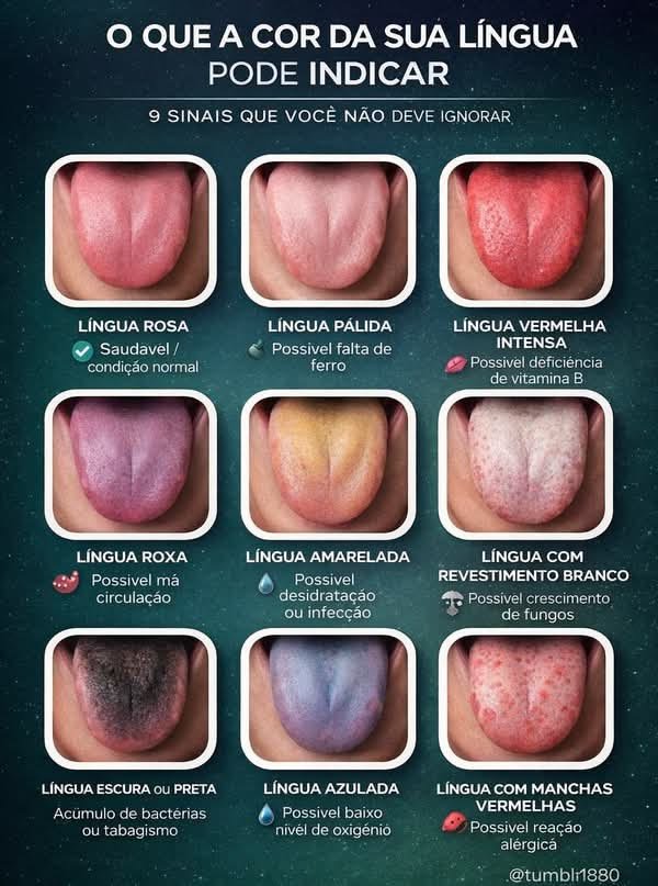 A saúde bucal é um aspecto essencial do bem-estar geral, e a **língua** pode ser um indicador importante de nossa saúde. Muitas vezes, ignoramos sinais que podem estar presentes na língua, mas eles podem fornecer pistas valiosas sobre nossa condição de saúde. Neste artigo, vamos explorar **nove sinais na língua que você não deve ignorar**, explicando o que cada um pode significar e como eles podem estar relacionados a diferentes condições de saúde. ### 1. Língua Rosa Uma **língua rosa** é geralmente um sinal de saúde. Quando a língua está nessa cor, indica que a circulação sanguínea está boa e que não há deficiências nutricionais significativas. Manter uma língua rosa é um bom indicativo de que sua saúde bucal está em dia. No entanto, é importante continuar com bons hábitos de higiene bucal para manter essa condição. ### 2. Língua Pálida Uma **língua pálida** pode ser um sinal de **deficiência de ferro** ou de vitamina B. Essas deficiências podem levar a condições como anemia, que pode causar fadiga e fraqueza. Se você notar que sua língua está mais pálida do que o normal, pode ser uma boa ideia consultar um médico para verificar seus níveis de ferro e vitaminas. ### 3. Língua Vermelha Uma **língua vermelha** pode indicar uma **possível inflamação** ou infecção. Em alguns casos, pode ser um sinal de deficiência de vitamina B, especialmente B12. A deficiência dessa vitamina pode levar a problemas neurológicos e outros sintomas graves, por isso é importante não ignorar esse sinal e procurar orientação médica. ### 4. Língua Roxa A presença de uma **língua roxa** pode sugerir **má circulação** ou problemas cardiovasculares. Isso ocorre porque a cor roxa pode indicar que o sangue não está circulando adequadamente. Se você perceber que sua língua está frequentemente roxa, é aconselhável procurar um médico para avaliar a saúde do seu sistema circulatório. ### 5. Língua Amarelada Uma **língua amarelada** pode ser um sinal de **desidratação** ou de problemas hepáticos. A desidratação pode ser facilmente corrigida aumentando a ingestão de líquidos, mas se a cor amarelada persistir, pode ser necessário investigar mais a fundo possíveis problemas no fígado. ### 6. Língua com Revestimento Branco Um **revestimento branco** na língua pode indicar o crescimento de fungos, como a candidíase oral. Essa condição é mais comum em pessoas com sistemas imunológicos comprometidos ou que estão tomando antibióticos. Manter uma boa higiene bucal e consultar um dentista pode ajudar a tratar essa condição. ### 7. Língua Escura ou Preta Uma **língua escura ou preta** pode ser causada pelo **acúmulo de bactérias** ou pelo tabagismo. Essa condição, conhecida como língua pilosa, pode ser tratada melhorando a higiene bucal e reduzindo o consumo de tabaco. Se a condição persistir, é importante buscar orientação médica. ### 8. Língua Azulada Uma **língua azulada** pode indicar um **baixo nível de oxigênio** no sangue, o que pode ser um sinal de problemas respiratórios ou cardíacos. Essa condição requer atenção médica imediata, pois pode ser um indicativo de problemas graves que precisam ser tratados rapidamente. ### 9. Língua com Manchas Vermelhas Manchas vermelhas na língua podem ser um sinal de uma **possível reação alérgica**. Se você notar manchas vermelhas acompanhadas de outros sintomas alérgicos, como inchaço ou dificuldade para respirar, é importante procurar atendimento médico imediatamente. ### Conclusão A língua pode ser um espelho da nossa saúde interna. Observar mudanças na cor ou textura da língua pode fornecer pistas valiosas sobre nossa saúde geral. Se você notar qualquer um desses sinais, é importante não ignorá-los e procurar orientação médica para garantir que qualquer condição subjacente seja tratada adequadamente. Manter uma boa higiene bucal e uma dieta equilibrada também pode ajudar a manter sua língua e sua saúde geral em boas condições.