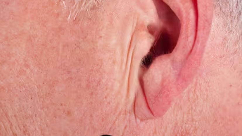 Uma simples **dobra na orelha** pode acender um alerta silencioso sobre algo muito maior — e é justamente isso que faz tanta gente parar diante do espelho e se perguntar se está vendo apenas uma marca comum ou um sinal que merece atenção. Mas que marca é essa, afinal? Trata-se de uma **linha diagonal no lóbulo da orelha**, uma prega que, à primeira vista, parece sem importância. Então por que ela desperta tanto interesse? Porque essa dobra, conhecida como **sinal de Frank**, vem sendo associada a um possível risco aumentado de **doenças cardiovasculares**. Isso significa que quem tem essa marca está com problema no coração? Não. E esse é o primeiro ponto que quase todo mundo entende errado. O sinal, por si só, **não fecha diagnóstico**, não confirma obstrução nas artérias e não prevê sozinho um **infarto**. Ainda assim, por que os médicos falam dele com tanta cautela? Porque ele pode funcionar como uma **pista clínica**, um aviso de que vale investigar melhor a saúde cardiovascular. Então por que essa dobra poderia ter alguma relação com o coração? A hipótese mais citada envolve o **envelhecimento precoce dos vasos sanguíneos** e a **aterosclerose**, condição em que placas de gordura se acumulam nas artérias. Mas há um ponto que pouca gente percebe: a ligação não estaria na orelha em si, e sim no que ela pode refletir sobre a condição dos vasos do corpo. Uma das explicações possíveis é a alteração nas **fibras de colágeno**, responsáveis pela elasticidade. Quando essa elasticidade se perde, os vasos ficam mais rígidos e mais vulneráveis. Se é só uma pista, por que tanta preocupação? Porque, em medicina, sinais externos às vezes ajudam a chamar atenção para algo que ainda não deu sintomas. E é aqui que muita gente se surpreende: também existem pessoas com **doença coronariana** que não têm essa dobra, assim como há quem tenha a prega e não apresente alterações nas artérias do coração. Ou seja, a presença da marca não condena ninguém, e a ausência dela também não tranquiliza por completo. Então o que realmente importa? Os **fatores de risco clássicos** continuam sendo os principais marcadores: **colesterol alto**, **hipertensão**, **diabetes** e **tabagismo**. É isso que os especialistas reforçam. O sinal de Frank pode chamar atenção, mas não substitui a avaliação do contexto geral, como **histórico familiar**, hábitos de vida e exames. Mas quando essa dobra merece mais atenção? Em geral, ela costuma aparecer com o passar dos anos e frequentemente surge nos dois lóbulos. O que acontece depois muda tudo: quando essa prega é observada em pessoas **mais jovens**, a preocupação tende a aumentar. Isso porque, nesse caso, ela pode sugerir um processo de envelhecimento vascular mais precoce, algo que merece investigação com mais cuidado. Quem descreveu esse sinal pela primeira vez? Foi o médico americano **Sanders Frank**, em **1973**. Desde então, o tema passou a ser estudado como um possível marcador associado à saúde das artérias. E há outro detalhe importante: especialistas explicam que as **extremidades do corpo** podem sofrer mais os efeitos de alterações vasculares. Em outras palavras, a orelha pode acabar mostrando, por fora, um reflexo do que está acontecendo por dentro. Então o que fazer ao notar essa linha no lóbulo? A orientação não é entrar em pânico, mas procurar **avaliação médica**. O passo mais importante é verificar a **pressão arterial** e investigar, de acordo com o perfil de cada pessoa, se há necessidade de exames. Em alguns casos, podem ser solicitados exames para avaliar melhor o estado do coração e das artérias. Se houver suspeita de obstruções importantes, exames mais detalhados, como o **cateterismo**, podem ser necessários. E o tratamento? Ele não depende da dobra, e sim do que os exames mostrarem. Pode envolver **mudanças no estilo de vida**, uso de **medicamentos** e, quando indicado, procedimentos para desobstruir artérias. Percebe a virada? O centro da questão nunca foi a orelha. O verdadeiro foco está no que ela pode estar tentando sinalizar. No fim, a resposta mais honesta é esta: o **sinal de Frank** não é sentença, não é diagnóstico e não deve ser interpretado isoladamente. Mas também não deve ser ignorado quando aparece junto de outros riscos. A dobra no lóbulo pode ser apenas uma marca do tempo — ou um lembrete discreto de que o coração talvez mereça mais atenção do que parece.