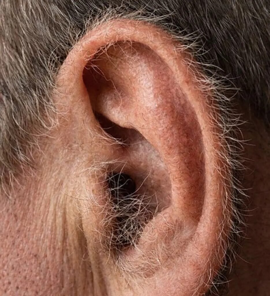 Você olha no espelho, percebe aqueles fios aparecendo na orelha e a primeira pergunta vem quase sem pedir licença: **o que o corpo está tentando dizer com isso**? É só uma mudança estética, daquelas que surgem com o tempo, ou existe algo mais acontecendo por trás? A dúvida faz sentido, porque esses pelos costumam aparecer de forma inesperada e chamam atenção justamente por surgirem em uma região que muita gente mal observa no dia a dia. Então por que eles aparecem? A resposta começa em um ponto que quase ninguém imagina de imediato: **os folículos pilosos** dessa área passam a reagir de forma diferente ao longo dos anos. E isso leva a uma nova pergunta: diferente por causa de quê? Principalmente por causa dos **hormônios andrógenos**, com destaque para a **testosterona**. Com o avanço da idade, os folículos das orelhas podem se tornar mais sensíveis a esses hormônios. E é aqui que muita gente se surpreende: os mesmos hormônios que podem contribuir para o afinamento dos cabelos no couro cabeludo também podem estimular o crescimento de pelos em áreas como **nariz** e **orelhas**. Mas se os hormônios já existem no corpo, por que isso fica mais visível só depois de um tempo? Porque não é apenas o estímulo hormonal que muda. O próprio **ciclo de crescimento dos pelos** também se altera. Em vez de crescerem e caírem com a mesma frequência de antes, eles podem permanecer mais tempo na fase de crescimento. O resultado? Ficam **mais longos**, mais aparentes e muito mais difíceis de ignorar. Só isso explica tudo? Ainda não. Há um detalhe que quase ninguém percebe: a **pele ao redor das orelhas** também muda com o passar do tempo. Ela tende a ficar mais fina e com menos elasticidade, o que faz com que os pelos se destaquem ainda mais. Ou seja, não é necessariamente que eles surgem do nada; muitas vezes, eles apenas passam a ficar mais visíveis. Mas será que isso acontece com todo mundo da mesma forma? Não. E aqui entra um fator decisivo: **genética**. Pessoas com histórico familiar de pelos abundantes nas orelhas têm maior chance de apresentar a mesma característica. Isso está ligado à maneira como os folículos reagem aos hormônios. E essa informação derruba uma ideia muito comum: não tem relação direta com **falta de higiene**, alimentação ou descuido pessoal. Se não é sujeira, nem desleixo, então isso pode indicar algum problema de saúde? Na maioria das vezes, **não**. Esses pelos costumam refletir apenas transformações naturais do corpo ao longo do tempo. Mas o que acontece depois muda tudo quando o padrão foge do habitual. Se houver um crescimento muito acelerado ou diferente do normal, especialmente acompanhado de **cansaço frequente**, **alterações de humor** ou outros sintomas persistentes, vale buscar orientação médica, porque isso pode acompanhar **variações hormonais**. E aquelas teorias antigas que ligavam pelos nas orelhas a problemas no coração? Essa é uma das partes mais importantes: **não há comprovação científica suficiente** para usar esse sinal como critério de avaliação cardiovascular. Ou seja, esse tipo de associação não deve ser tratado como diagnóstico. Então esses pelos servem para alguma coisa ou estão ali sem função? Servem, sim. Eles têm um papel **protetor**, ajudando a dificultar a entrada de **poeira** e pequenas partículas. Isso levanta outra dúvida inevitável: se eles têm função, é errado remover? Não necessariamente. A remoção não é obrigatória, a menos que exista desconforto estético ou físico. Se a ideia for cuidar da região, o mais seguro é usar **aparadores elétricos próprios** para essa área. Também é possível usar **tesouras com ponta arredondada**, mas apenas nos pelos visíveis e com bastante atenção diante do espelho. E arrancar com pinça, pode? O mais indicado é evitar. A **pinça** pode causar **inflamações** ou até **infecções**. Já procedimentos com **cera** ou limpezas mais profundas devem ser feitos apenas por profissionais, sempre sem introduzir objetos no canal auditivo. No fim, a resposta para aquela primeira pergunta é mais simples — e mais curiosa — do que parece: se crescem pelos nas suas orelhas, é porque o seu corpo está passando por **mudanças naturais ligadas à idade, aos hormônios, à genética e à própria pele**. Só que o detalhe mais interessante talvez seja outro: aquilo que muita gente vê como um incômodo pode ser apenas um sinal discreto de que o corpo continua mudando, mesmo em lugares onde quase ninguém presta atenção. E talvez seja justamente por isso que esse assunto desperte tanta curiosidade.