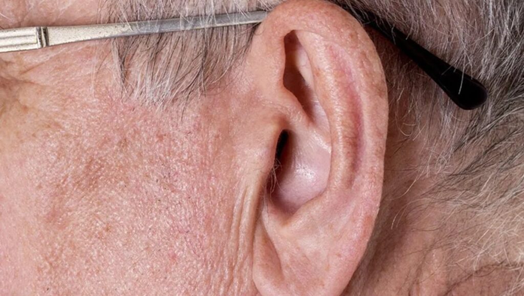 Um simples vinco em diagonal no lóbulo da orelha, que muita gente sempre tratou como detalhe estético sem importância, está sendo apontado por cardiologistas como possível aviso de risco silencioso de infarto precoce. O chamado “sinal de Frank” voltou aos holofotes depois de um vídeo do Dr. Sergio Francisco, do perfil Café com Cardio, e acendeu a preocupação de quem nunca imaginou que a orelha pudesse denunciar o coração. O que é esse vinco na orelha? É uma prega diagonal bem visível atravessando o lóbulo, em uma ou nas duas orelhas. Pode existir desde cedo ou ficar mais marcado com o tempo. Não é diagnóstico de nada por si só, mas vem sendo estudado desde os anos 1970 como possível marcador associado à doença arterial coronariana, o entupimento das artérias do coração. Esse vinco realmente indica infarto precoce? Não, ele não confirma infarto. Os estudos mostram associação, não certeza. A revisão sistemática de 2021 concluiu que o sinal, isolado, não tem precisão suficiente para diagnosticar doença coronariana. Mas vários trabalhos observacionais apontam que quem tem o vinco tem maior probabilidade de já apresentar doença nas artérias do coração, principalmente quando é mais jovem. Por que cardiologistas estão falando disso agora? Porque o tema explodiu nas redes em meio à comoção pela morte do influenciador Henrique Maderite, confirmada como infarto fulminante em 9 de fevereiro de 2026. A coincidência de vídeos sobre o sinal de Frank com a notícia do infarto em alguém relativamente jovem fez muita gente olhar para a própria orelha pela primeira vez. Esse vinco aparece em qualquer idade? Sim, mas preocupa mais jovens. Em idosos, sulcos e pregas de pele são comuns por vários motivos. Em pessoas abaixo de 60–65 anos, um marcador físico incomum chama mais atenção como possível sinal de triagem de risco cardiovascular. Qual a possível explicação para o sinal? Alterações em microvasos e no tecido conjuntivo, como elastina e colágeno, que acompanham envelhecimento e aterosclerose. O lóbulo da orelha, por ser área pequena e visível, poderia “mostrar” mudanças que também acontecem em vasos do corpo. É uma hipótese plausível, mas ainda não é prova definitiva. Tenho esse vinco. Devo me desesperar? Não, desespero não ajuda. O recado dos especialistas é usar o sinal como gatilho para fazer o básico que muita gente negligencia: checar pressão, colesterol, glicemia, peso, parar de fumar, rever alimentação, sedentarismo e sono. Ou seja, cuidar dos fatores que realmente mudam o risco de infarto. Esse vinco substitui exames do coração? De jeito nenhum, nunca substitui. Ele pode servir como alerta extra, principalmente em quem é jovem e já acumula outros fatores de risco. Mas diagnóstico de doença coronariana continua dependendo de avaliação médica, exames de sangue, testes de esforço, imagem e acompanhamento. Por que chamam de risco silencioso? Porque o coração pode adoecer sem sintomas. Muita gente só descobre o problema no momento do infarto. Um sinal visível, ainda que imperfeito, pode ser a única “pista” que faça a pessoa procurar um cardiologista antes da tragédia. Quais sintomas exigem atendimento imediato? Dor ou pressão no peito, falta de ar fora do normal, desmaio, suor frio, mal-estar intenso. Nesses casos, não é para esperar “ver se passa”: é procurar urgência na hora. Todo vinco na orelha é perigoso? Não, nem todo vinco preocupa. Em pessoas mais velhas, pode ser apenas efeito do envelhecimento da pele. O contexto é que manda: idade, histórico familiar, estilo de vida e outros fatores de risco. Esse sinal some se eu tratar? Não há garantia de desaparecimento. O foco não é “apagar” o vinco, e sim reduzir o risco real de infarto com mudanças de hábito e acompanhamento médico. Por que esse assunto incomoda tanta gente? Porque escancara o quanto o brasileiro ignora sinais do próprio corpo e só corre atrás quando a tragédia já aconteceu. Enquanto muita gente gasta tempo com modismo de saúde nas redes, um simples vinco na orelha pode ser o empurrão que faltava para fazer o check-up que vem sendo adiado há anos. Esse vinco é sentença de morte? Não, não é sentença automática. É um aviso incômodo, mas útil: se você tem o sinal de Frank, principalmente sendo jovem, a mensagem é clara — pare de empurrar com a barriga o cuidado com o coração. Infarto fulminante não marca horário, não avisa com antecedência e não escolhe só “gente mais velha”. Até quando vamos ignorar isso? Até quando vamos fingir que está tudo bem, enquanto o corpo grita por atenção em detalhes que sempre chamamos de “normal” ou “coisa de família”? O vinco na orelha não é profecia, mas é um lembrete duro: quem deixa o coração para depois pode não ter depois. Esse vinco merece investigação médica? Sim, merece avaliação cuidadosa. Principalmente se você é abaixo de 60–65 anos e já tem outros fatores de risco, o caminho responsável é marcar consulta, fazer exames e encarar a realidade. Melhor descobrir cedo do que virar mais um caso de infarto “inesperado” que poderia ter sido evitado. Por que esse vinco assusta tanto? Porque mostra que o corpo fala. E, quando o assunto é coração, ignorar o que ele está dizendo pode custar caro demais.