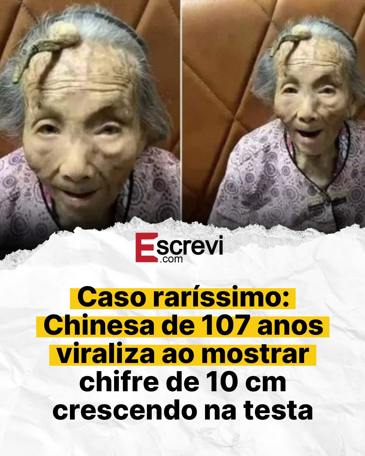 Caso raríssimo: Chinesa de 107 anos viraliza ao mostrar chifre de 10 cm crescendo na testa card branco
