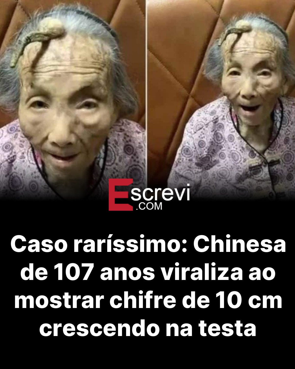 Caso raríssimo: Chinesa de 107 anos viraliza ao mostrar chifre de 10 cm crescendo na testa card preto