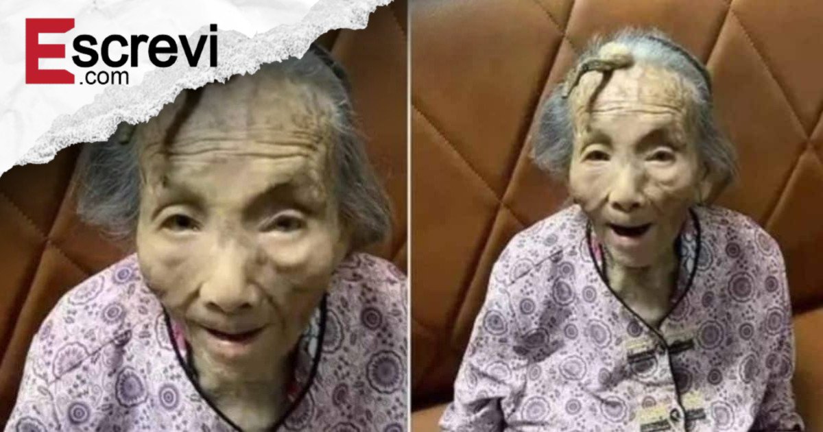 Caso raríssimo: Chinesa de 107 anos viraliza ao mostrar chifre de 10 cm crescendo na testa imagem principal