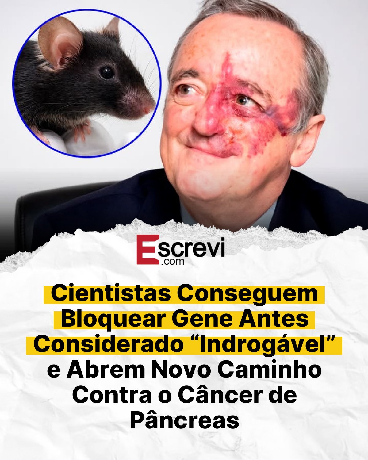 Cientistas Conseguem Bloquear Gene Antes Considerado “Indrogável” e Abrem Novo Caminho Contra o Câncer de Pâncreas card branco