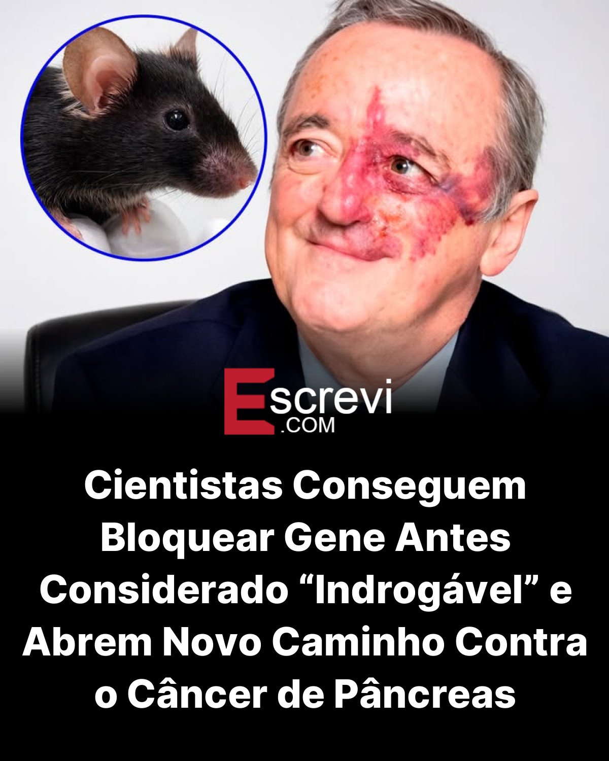 Cientistas Conseguem Bloquear Gene Antes Considerado “Indrogável” e Abrem Novo Caminho Contra o Câncer de Pâncreas card preto