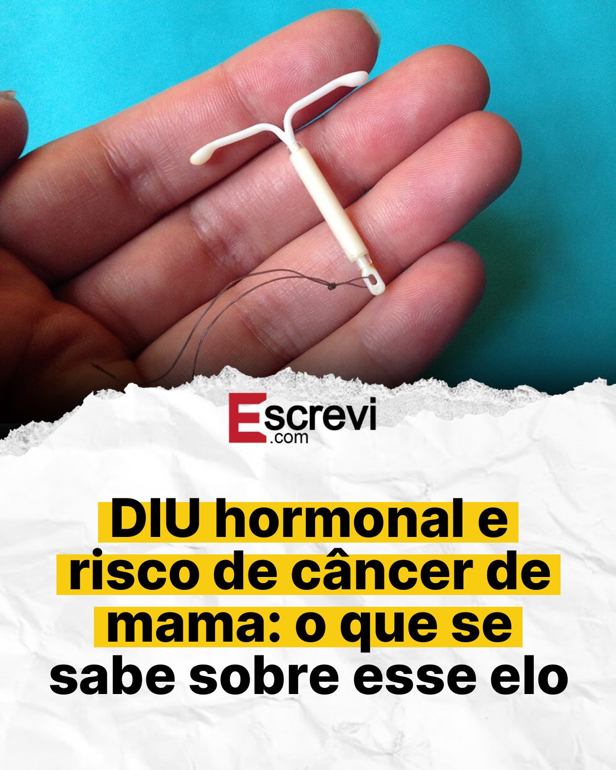 DIU hormonal e risco de câncer de mama: o que se sabe sobre esse elo card branco