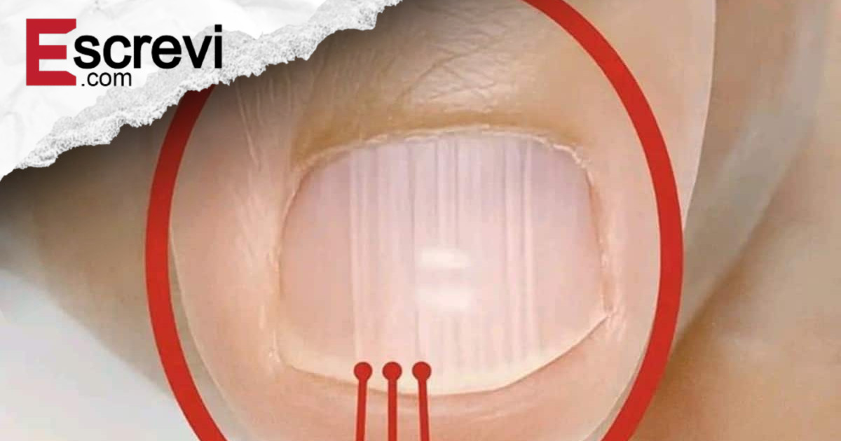 Essas linhas nas unhas depois dos 40 podem dizer mais sobre sua saúde do que você imagina imagem principal