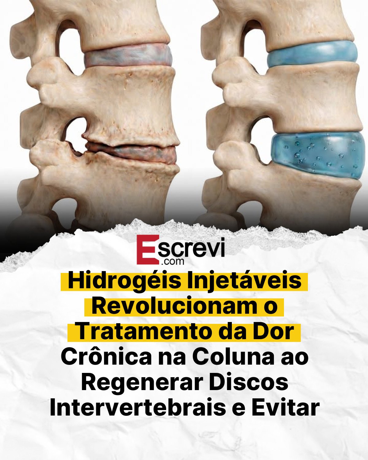 Hidrogéis Injetáveis Revolucionam o Tratamento da Dor Crônica na Coluna ao Regenerar Discos Intervertebrais e Evitar Cirurgias Invasivas card branco