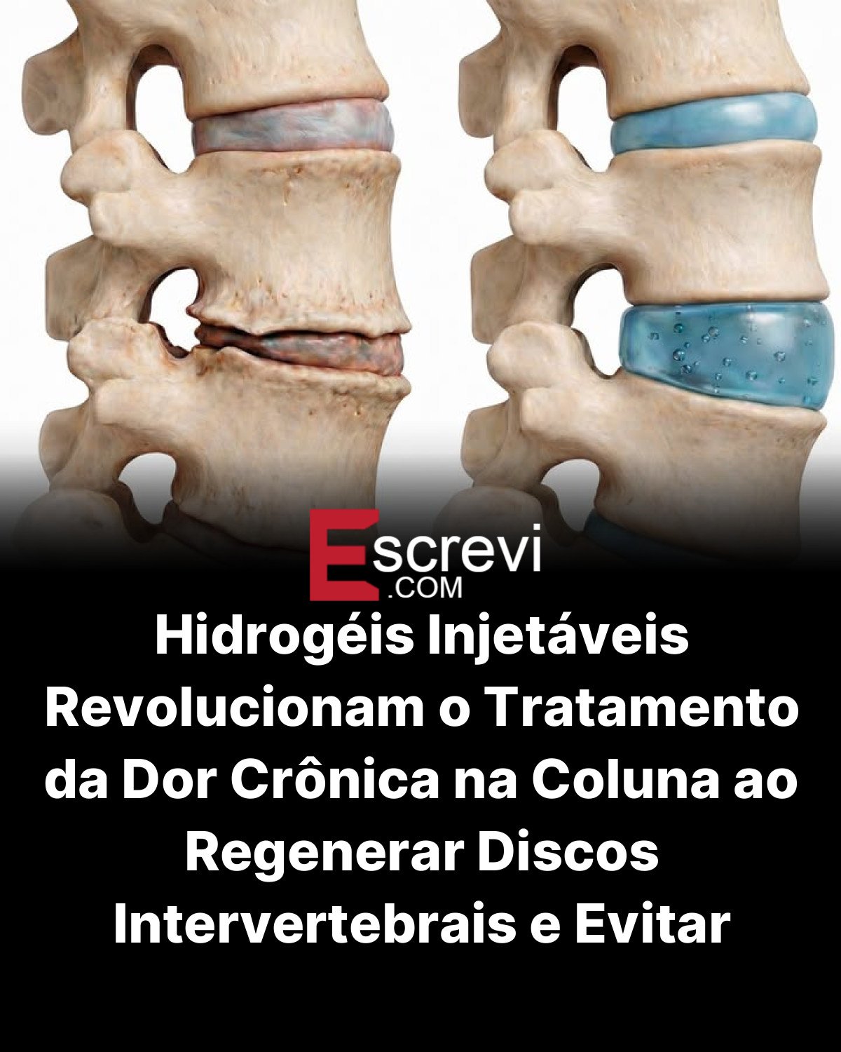 Hidrogéis Injetáveis Revolucionam o Tratamento da Dor Crônica na Coluna ao Regenerar Discos Intervertebrais e Evitar Cirurgias Invasivas card preto