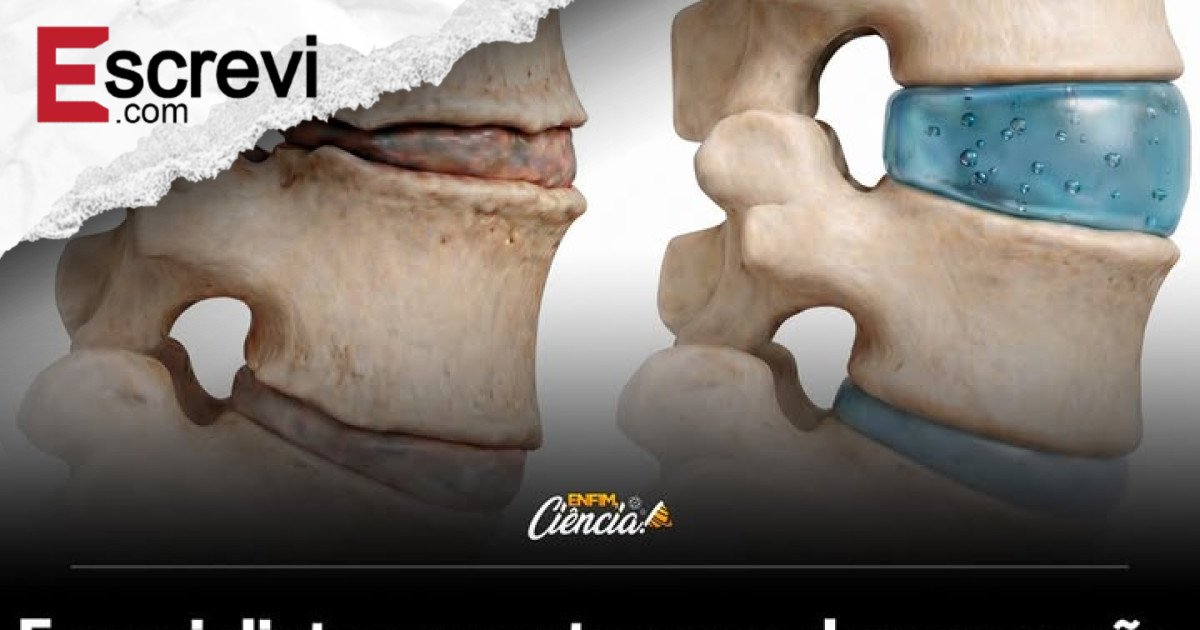 Hidrogéis Injetáveis Revolucionam o Tratamento da Dor Crônica na Coluna ao Regenerar Discos Intervertebrais e Evitar Cirurgias Invasivas imagem principal