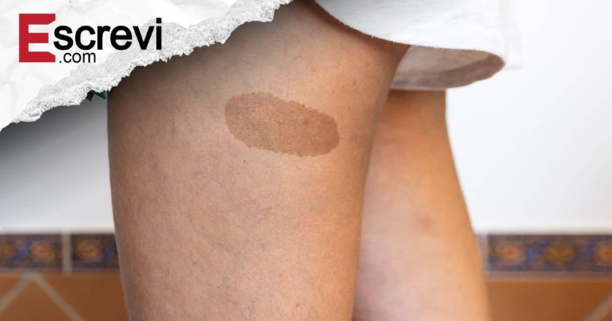 Marcas de nascença têm significado oculto? A espiritualidade revela o que ninguém te contou imagem principal