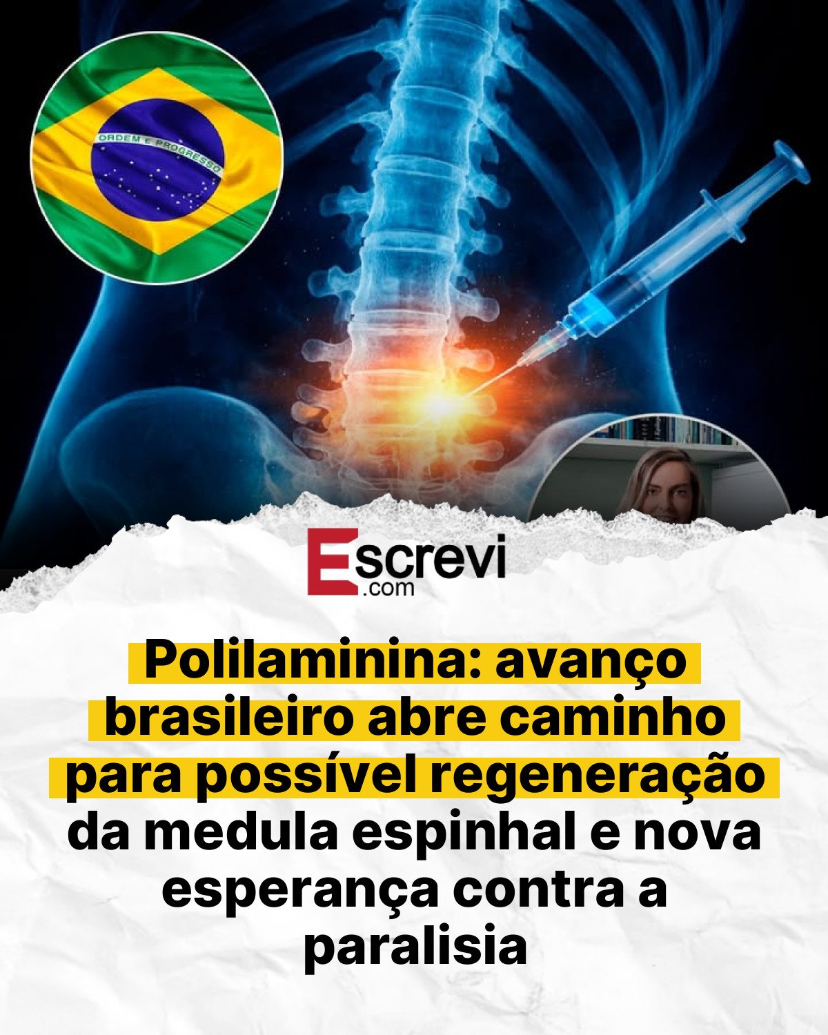 Polilaminina: avanço brasileiro abre caminho para possível regeneração da medula espinhal e nova esperança contra a paralisia card branco