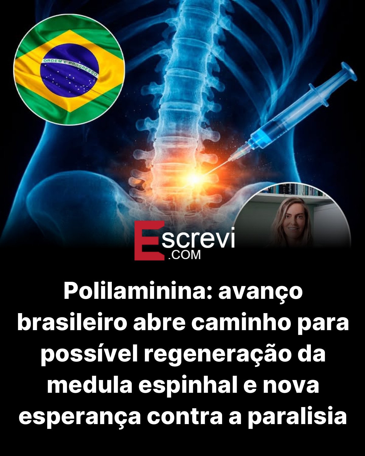 Polilaminina: avanço brasileiro abre caminho para possível regeneração da medula espinhal e nova esperança contra a paralisia card preto