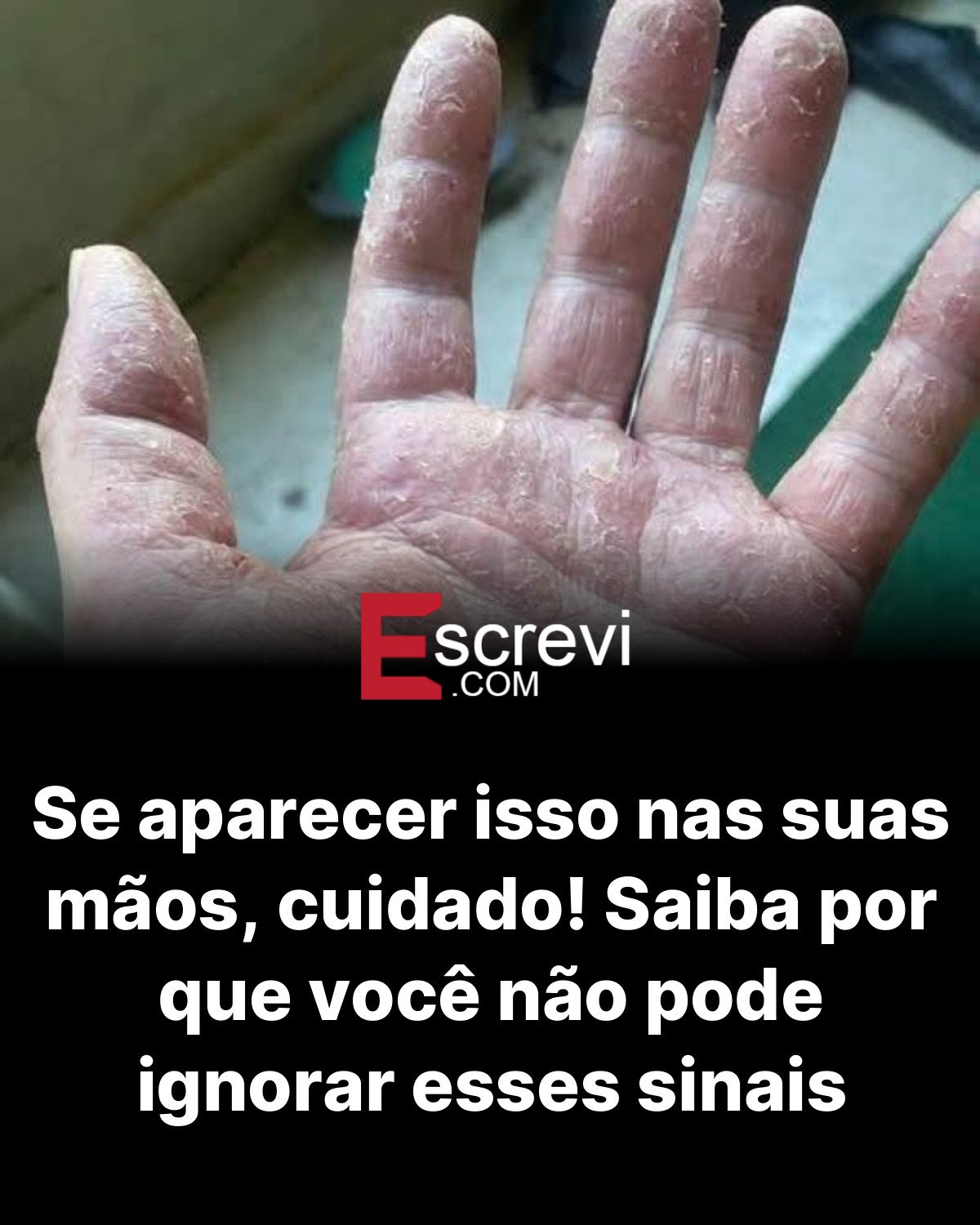 Se aparecer isso nas suas mãos, cuidado! Saiba por que você não pode ignorar esses sinais card preto