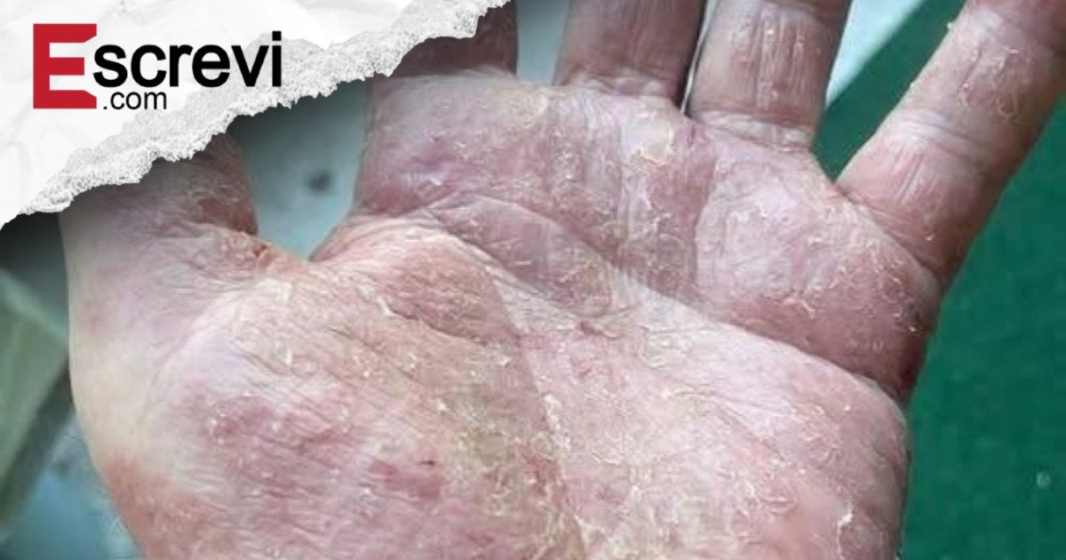 Se aparecer isso nas suas mãos, cuidado! Saiba por que você não pode ignorar esses sinais imagem principal