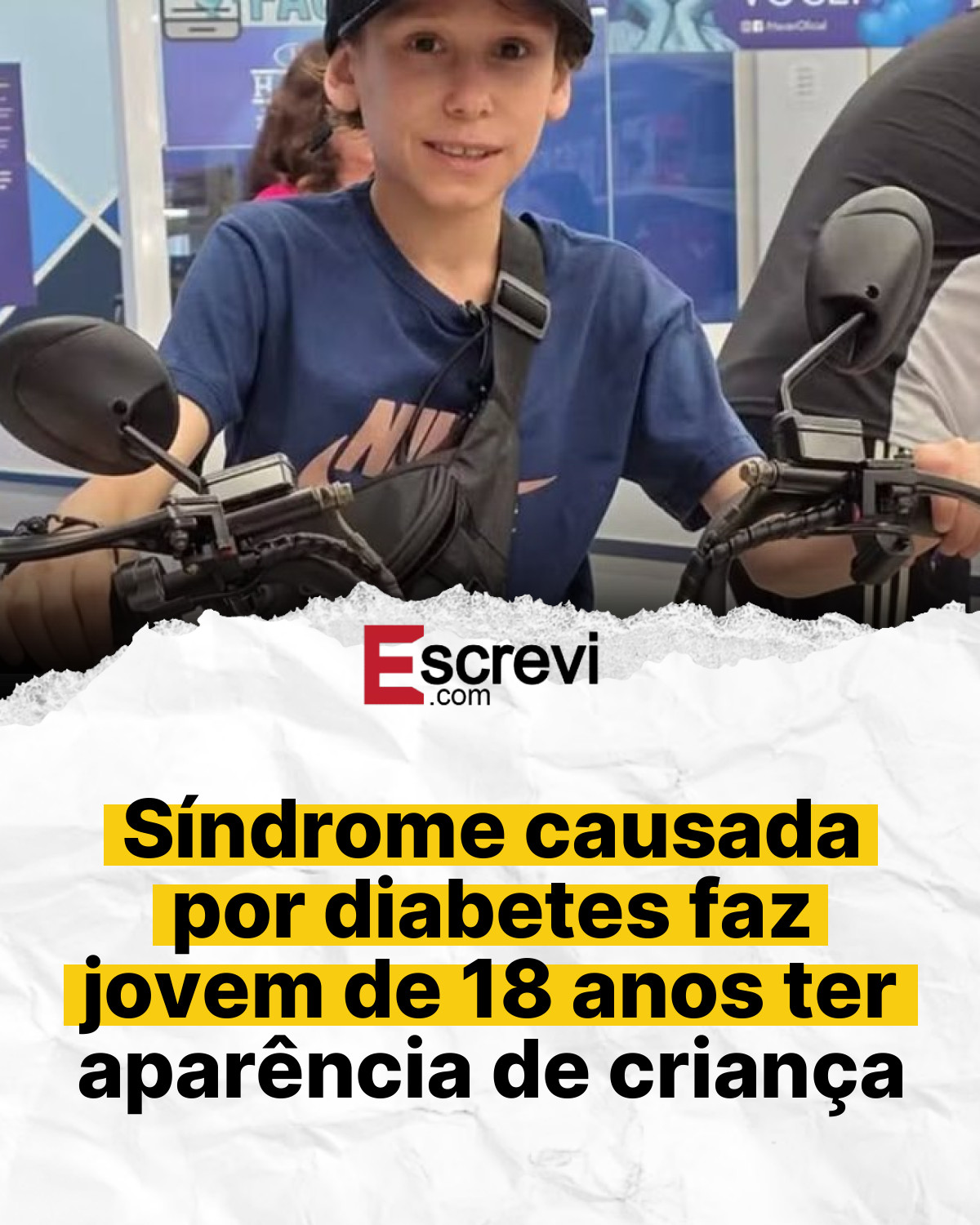 Síndrome causada por diabetes faz jovem de 18 anos ter aparência de criança card branco