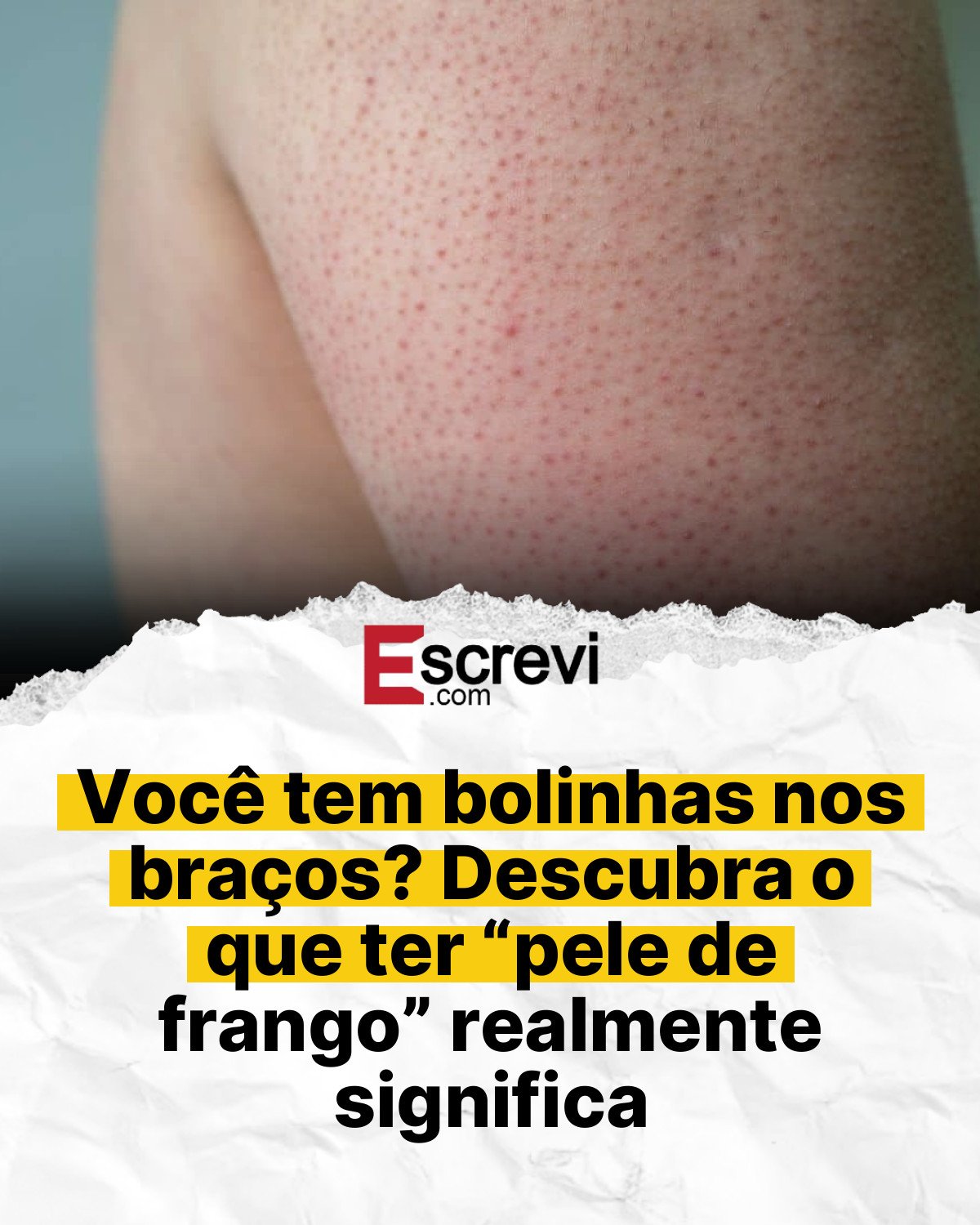 Você tem bolinhas nos braços? Descubra o que ter “pele de frango” realmente significa card branco