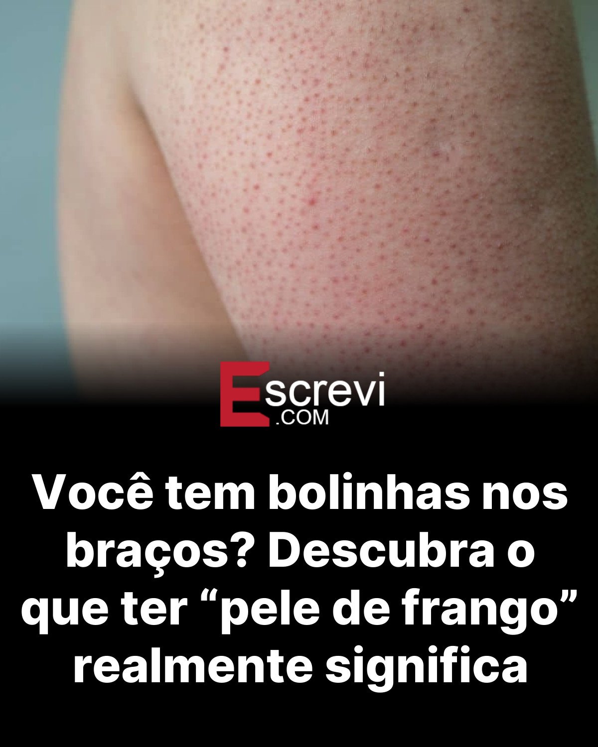 Você tem bolinhas nos braços? Descubra o que ter “pele de frango” realmente significa card preto