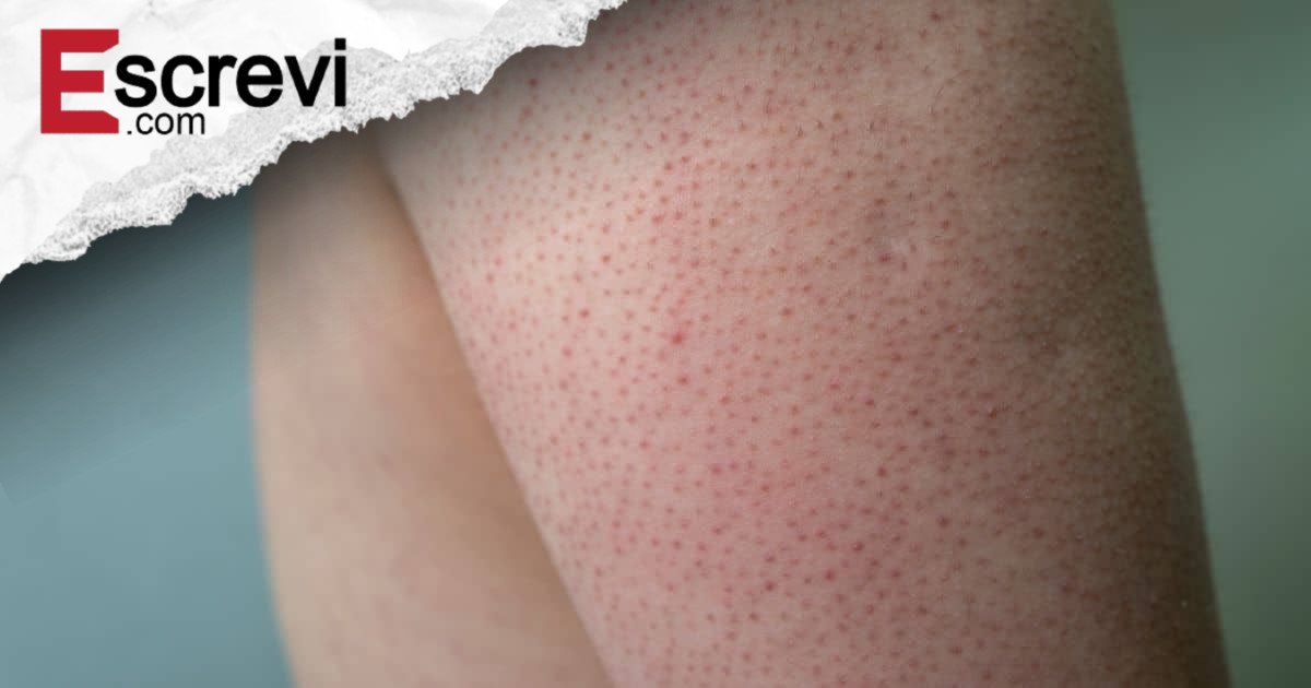 Você tem bolinhas nos braços? Descubra o que ter “pele de frango” realmente significa imagem principal