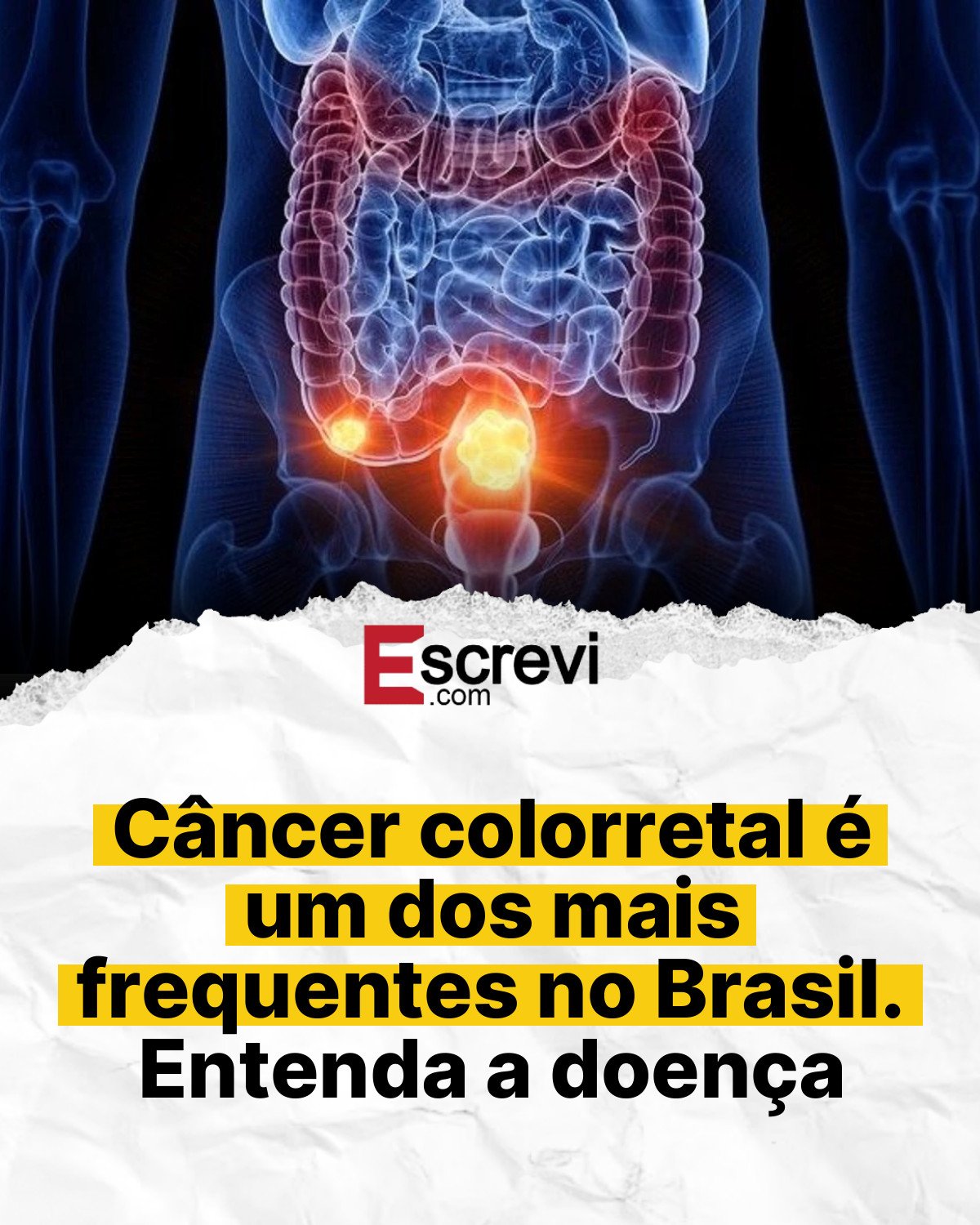 Câncer colorretal é um dos mais frequentes no Brasil. Entenda a doença card branco