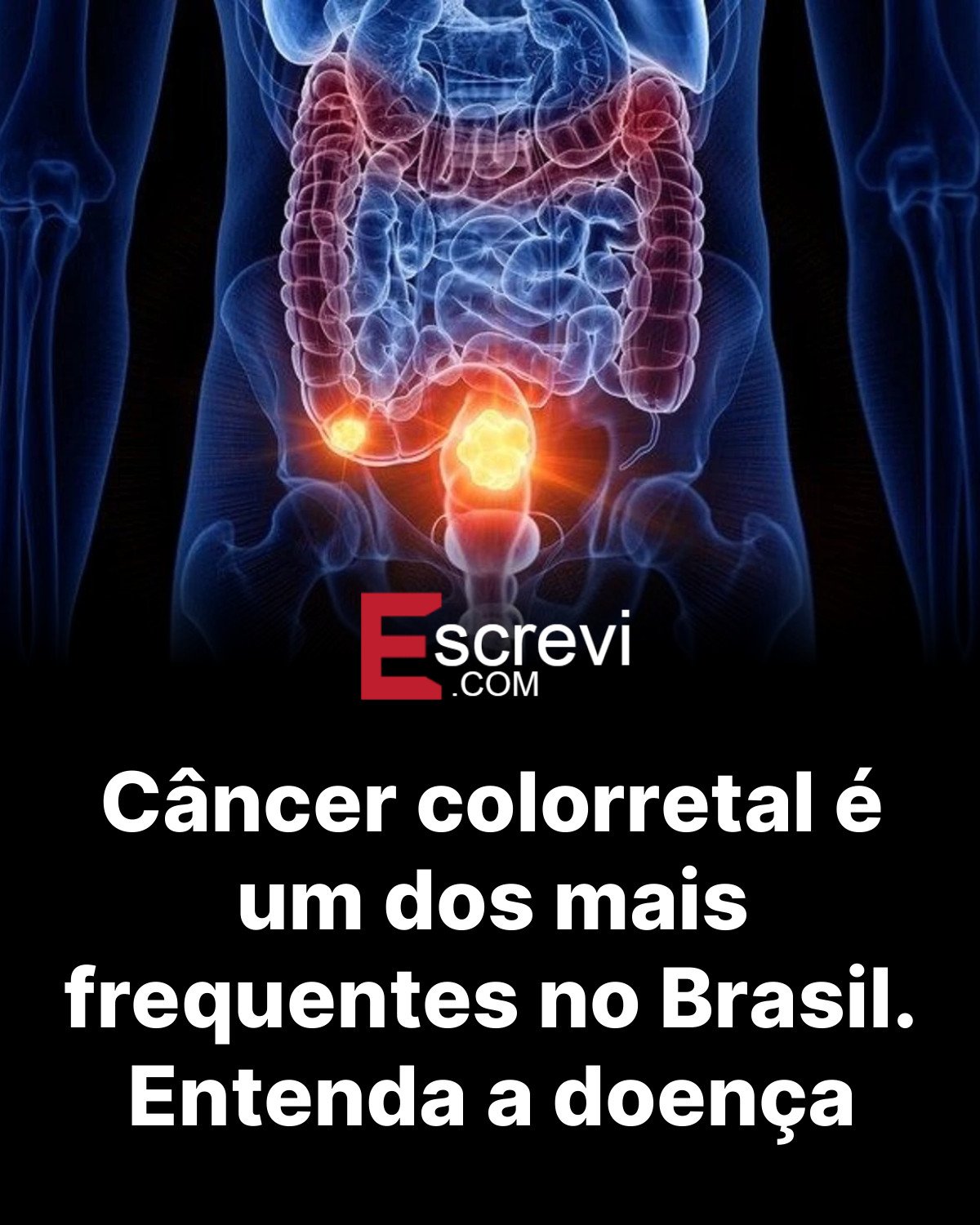 Câncer colorretal é um dos mais frequentes no Brasil. Entenda a doença card preto