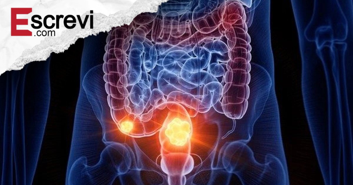 Câncer colorretal é um dos mais frequentes no Brasil. Entenda a doença imagem principal
